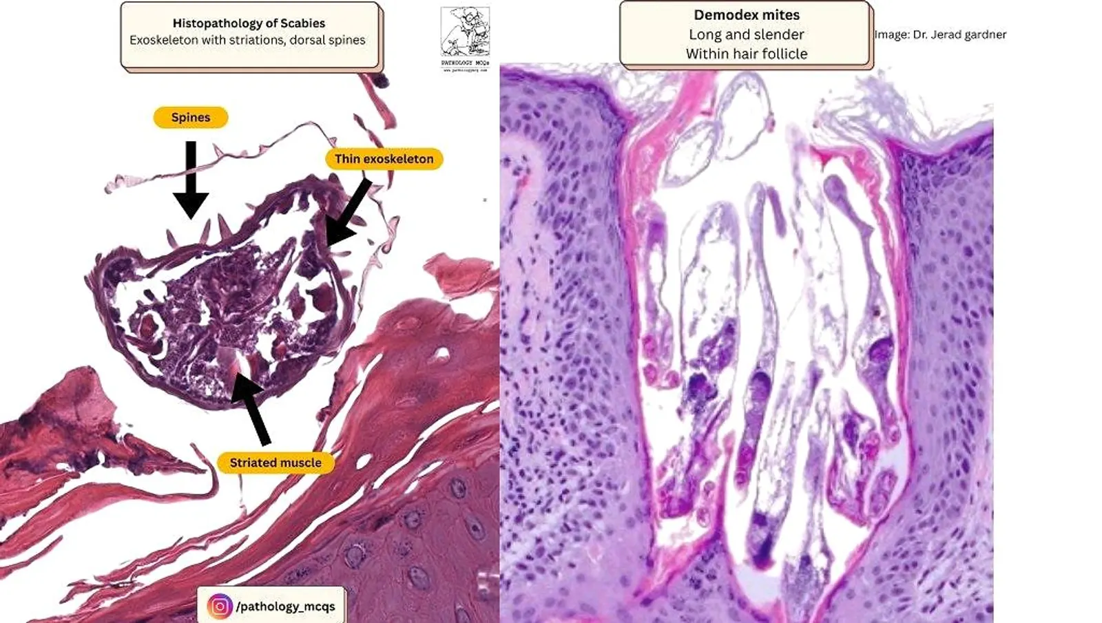 Histopathology of scabies showing the mite's thin exoskeleton, striated muscle fibers, and dorsal spines, with a comparison to Demodex mites found within hair follicles.