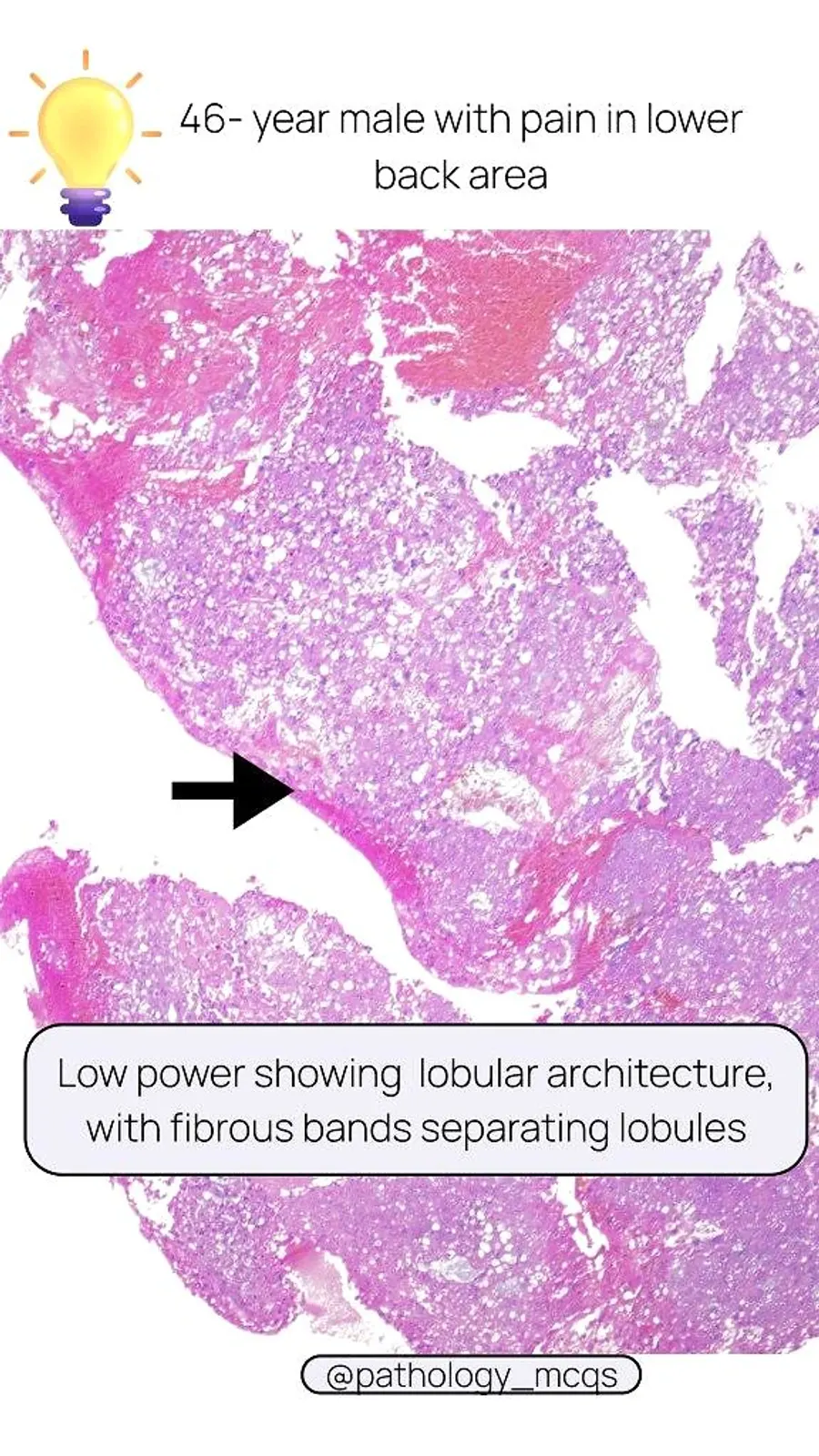 Low power microscopy image showing lobular architecture of tumor with fibrous bands separating lobules.