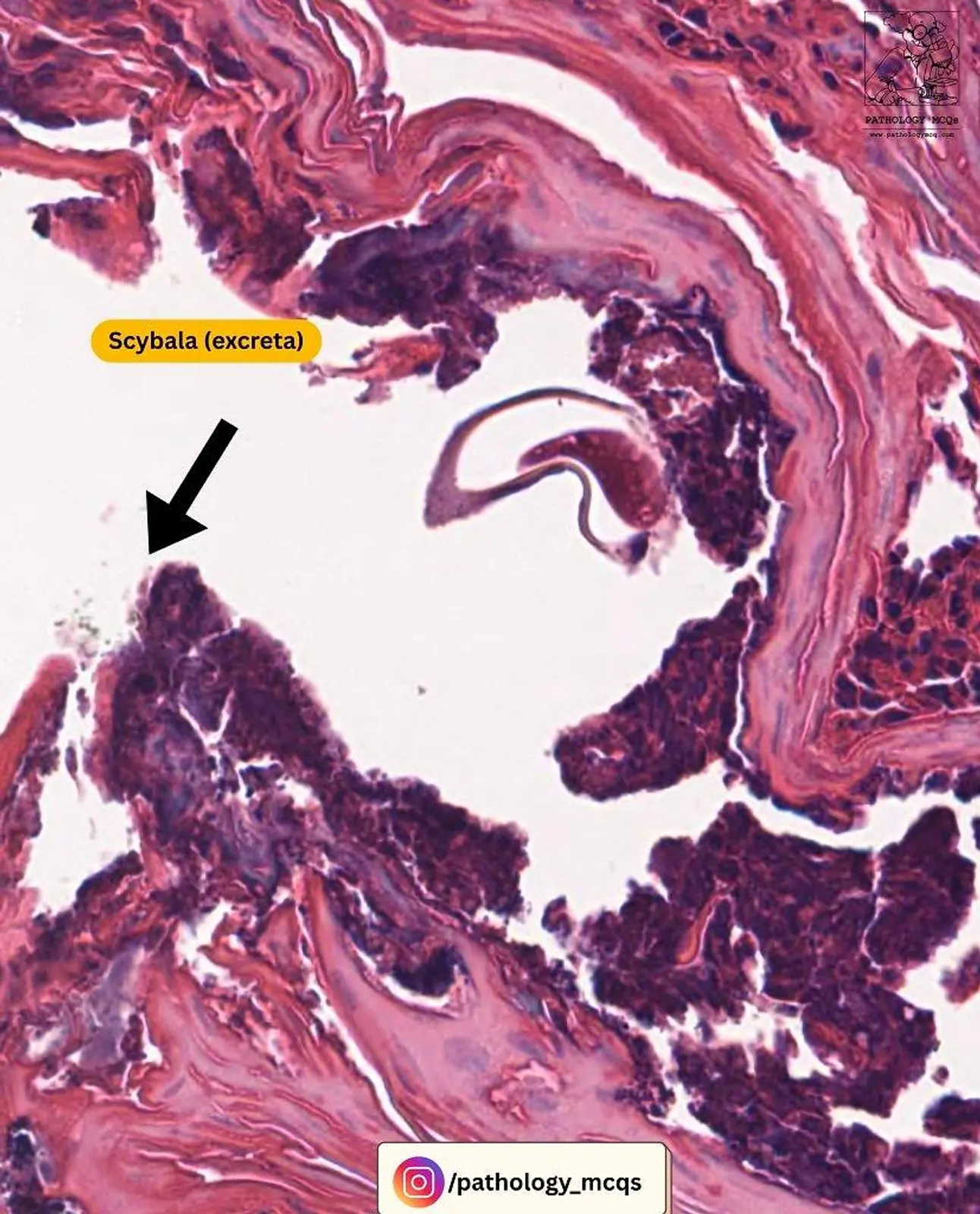 Histological image of scybala (fecal pellets) from Sarcoptes scabiei in the skin, showing dark granular clumps and surrounding tissue.