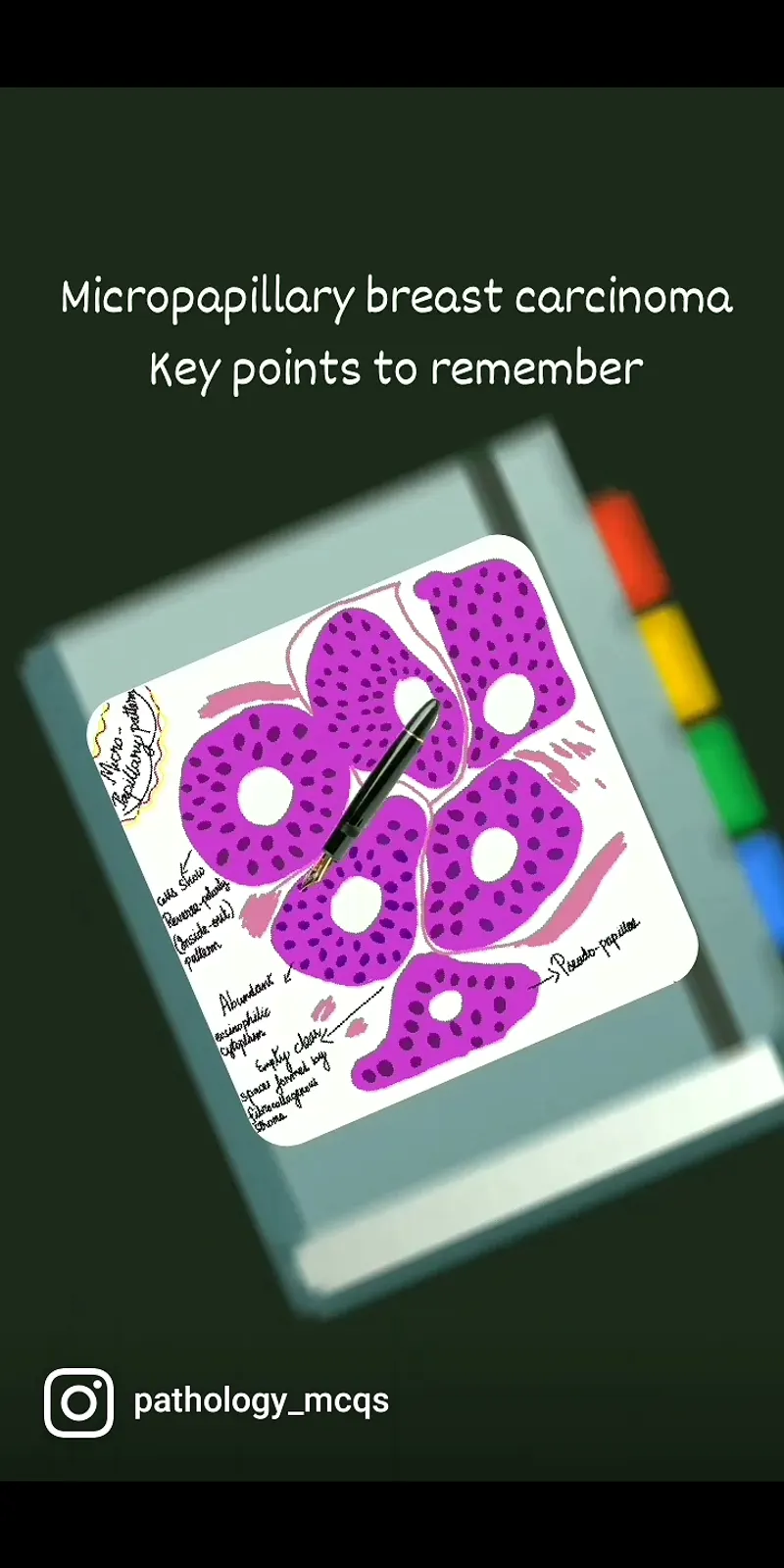 6 KEY POINTS FOR BOARDS - MICROPAPILLARY BREAST CARCINOMA