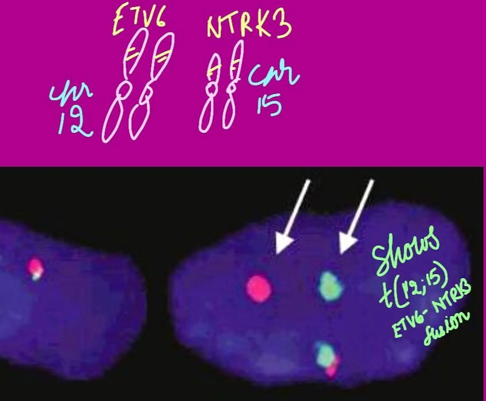 Key points- Must know for boards about Secretory carcinoma breast1.Presence of microcystic,   solid or tubular pattern 2. PAS- Positive and  diastase resistant 3. ETV-6 NTR3 t(12;15)   is seen in these tumors 4. Common in children but can occur in all age groups 5. Often triple negative ( ER, PR and Her-2 negative)  6. Even though these tumors are triple negative- TP53 mutation is uncommon.  7. Lack gain of 1q and loss of 16q seen in low grade pathway