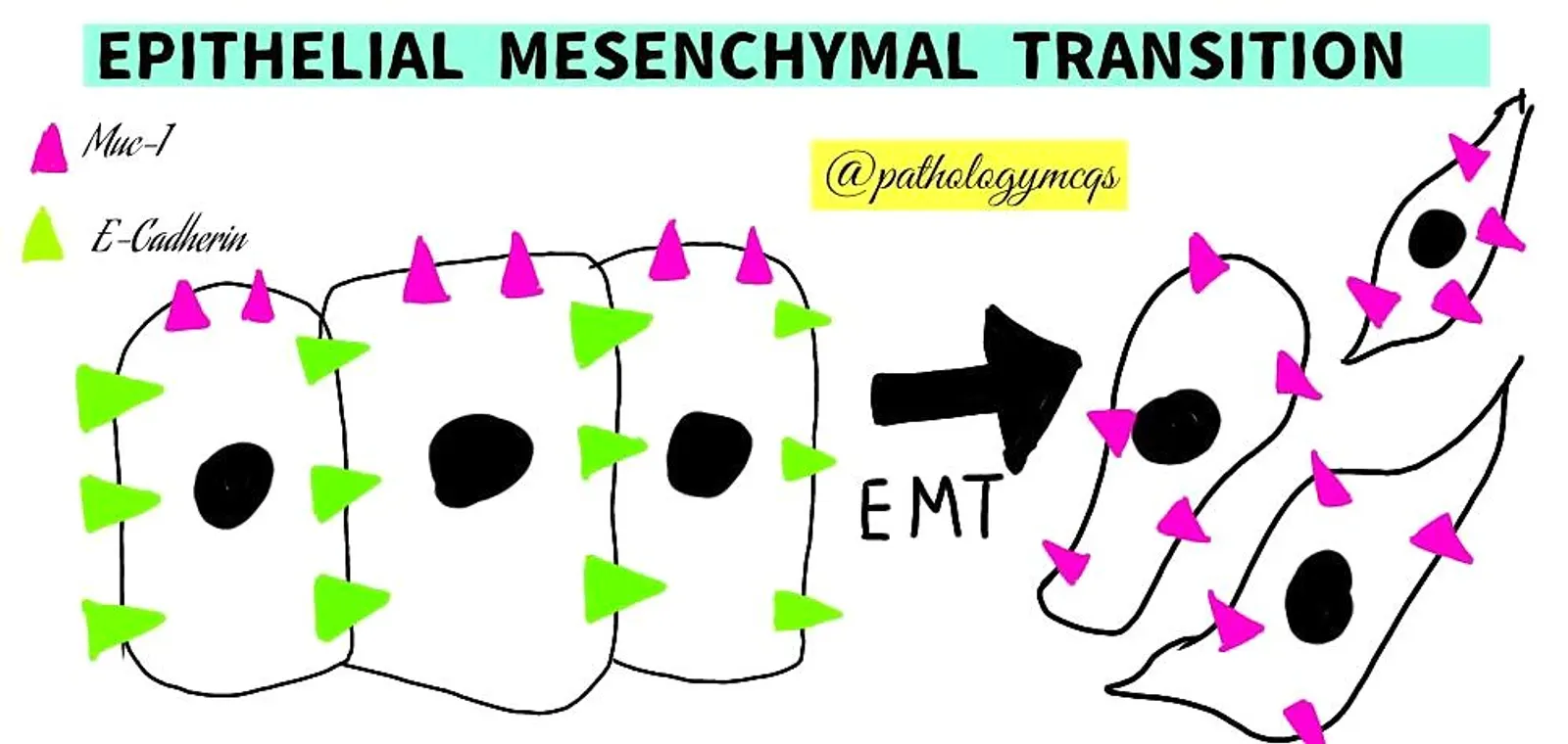 EMT- Epithelial mesenchymal transition
1. It is integral to breast and prostrate cancers. 
2. EMT is controlled by SNAIL and TWIST proteins. 
3. Down regulation of epithelial markers and upregulation of mesenchymal markers. 
4. E cadherin    expression is slilenced
5. Strong migratory potential

