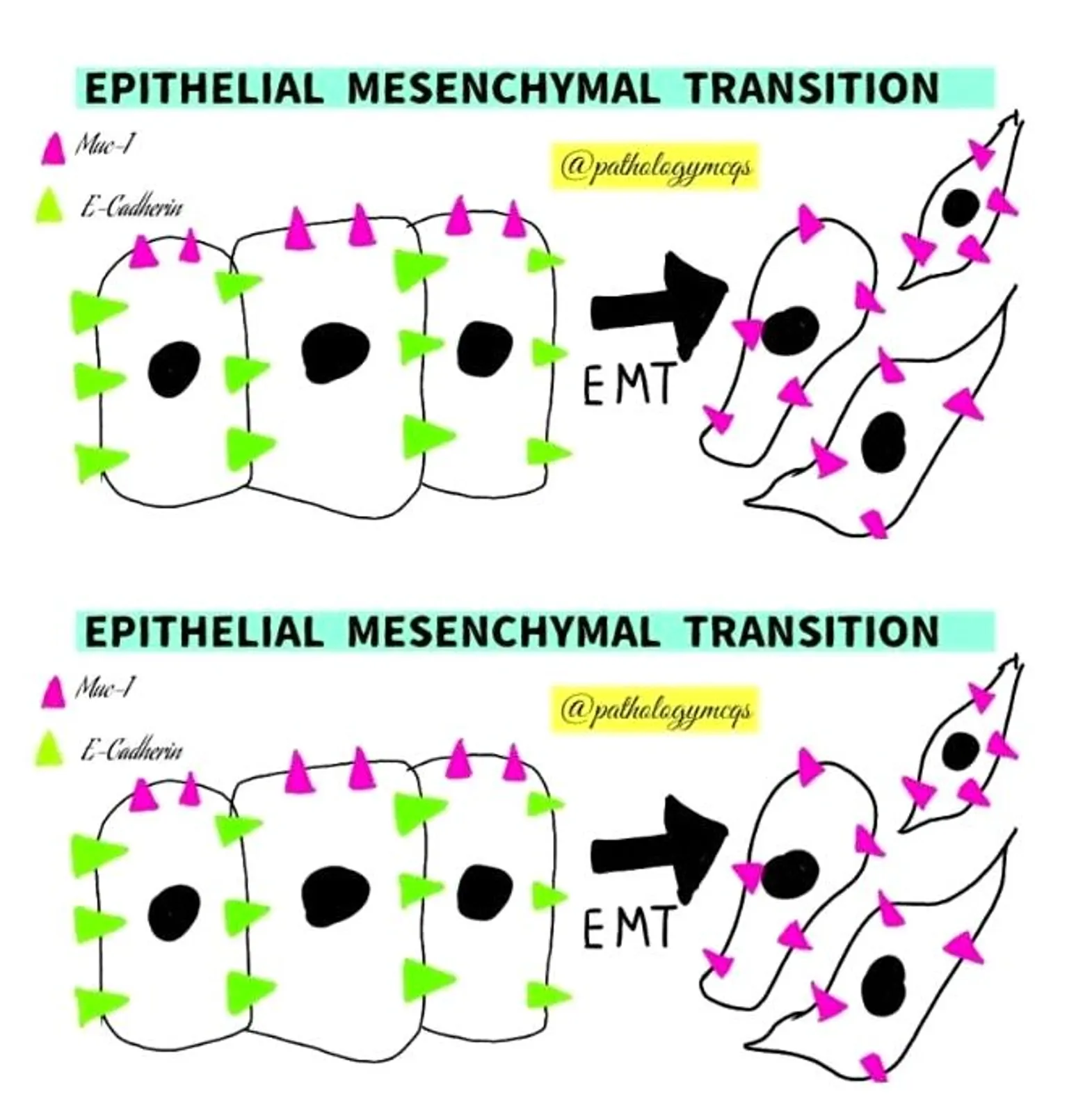 Characteristics of Epithelial-Mesenchymal transition