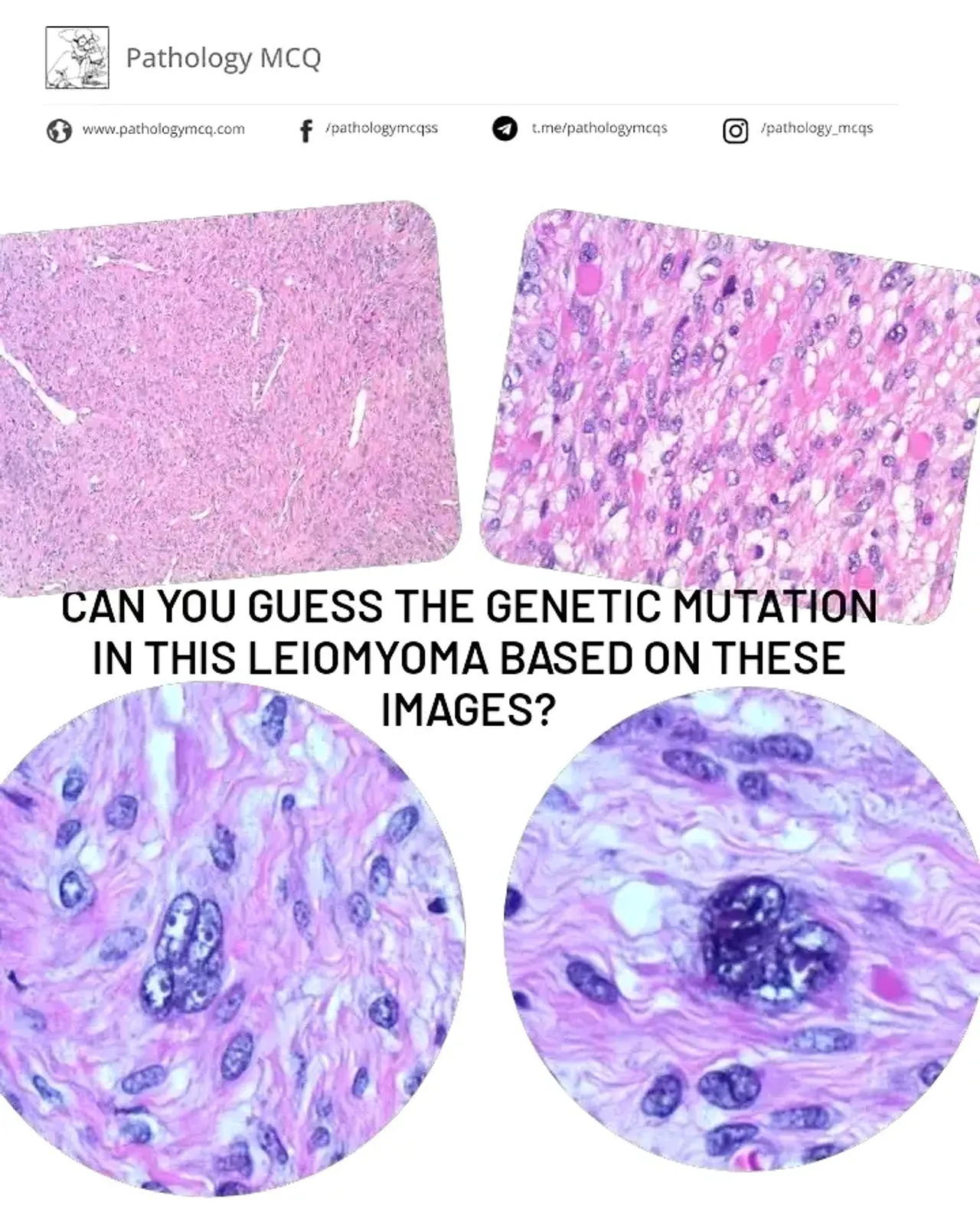 CAN YOU GUESS THE TYPE OF LEIOMYOMA BASED ON THE MORPHOLOGY?