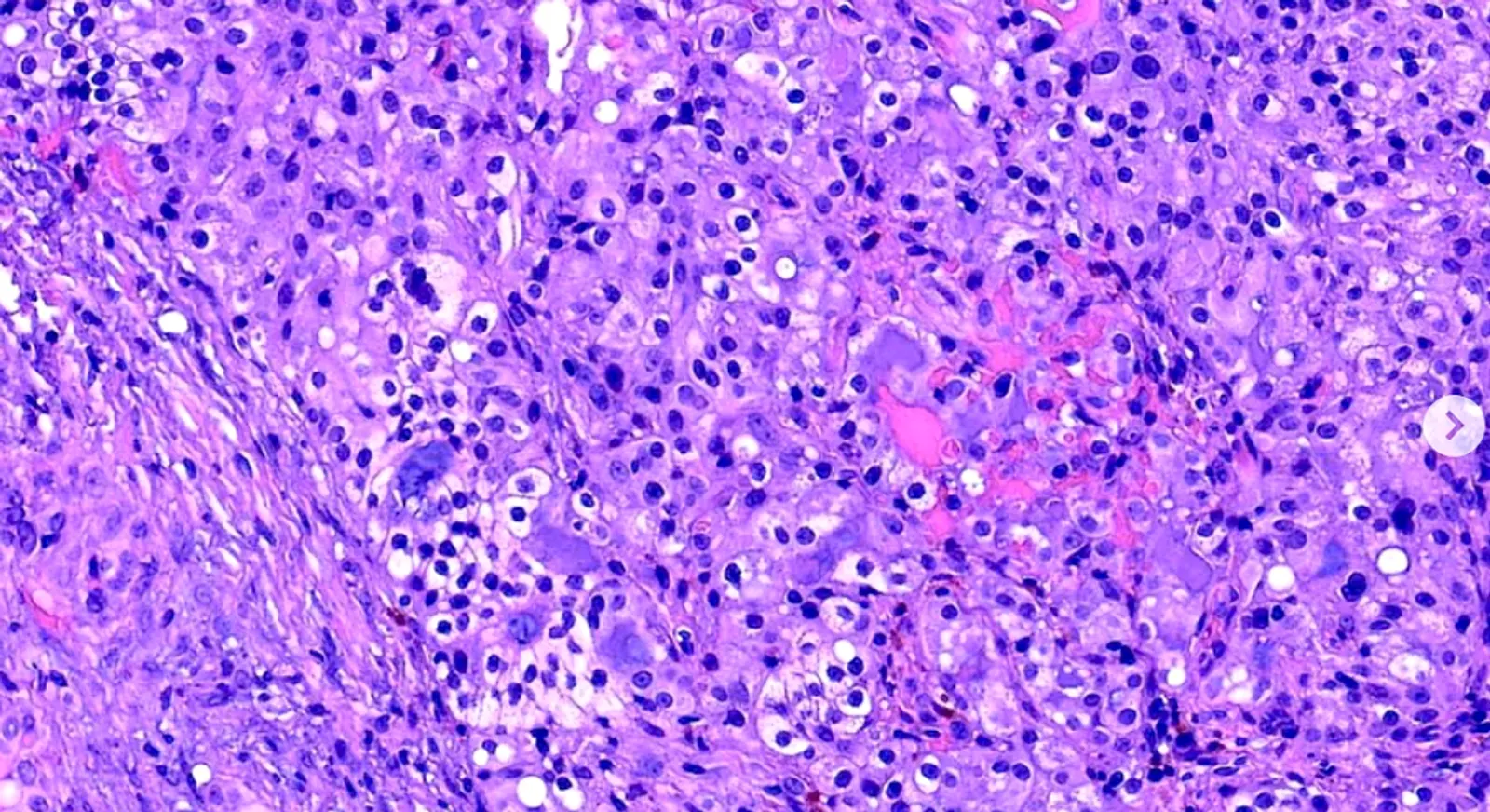 This image shows a high-resolution histopathological slide of salivary gland tumor cells, highlighting the structural changes at a microscopic level. The cellular alterations reflect underlying genetic mutations, which are critical in diagnosing and understanding the behavior of these tumors. The detailed view demonstrates irregularities in cellular morphology, which correlate with specific genetic markers commonly found in malignant salivary gland tumors