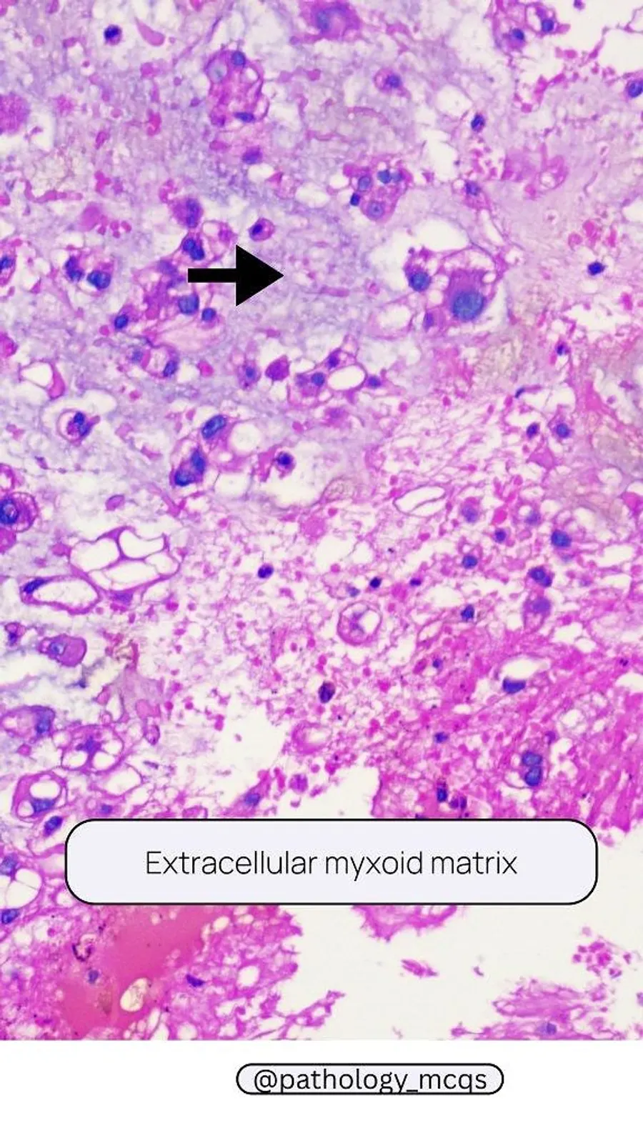Microscopic view of a myxoid matrix with scattered tumor cells, stained to highlight cellular structure and extracellular components, labeled as 'Extracellular myxoid matrix'.
