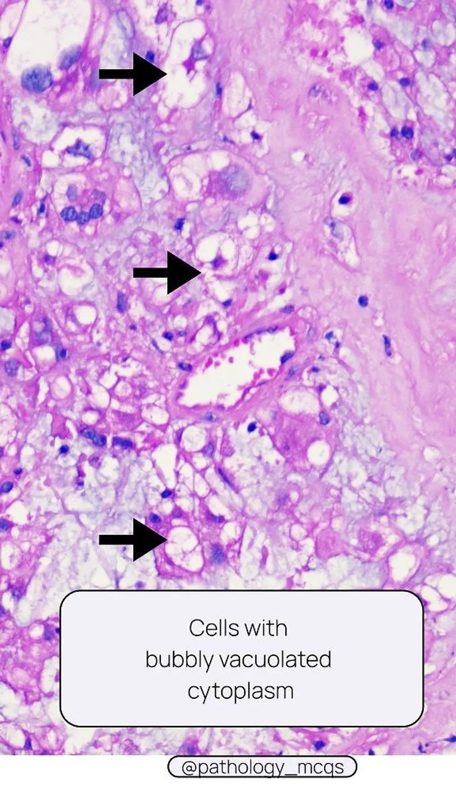 Microscopic view of tumor cells exhibiting bubbly vacuolated cytoplasm, indicated by arrows. The background shows a myxoid stroma.