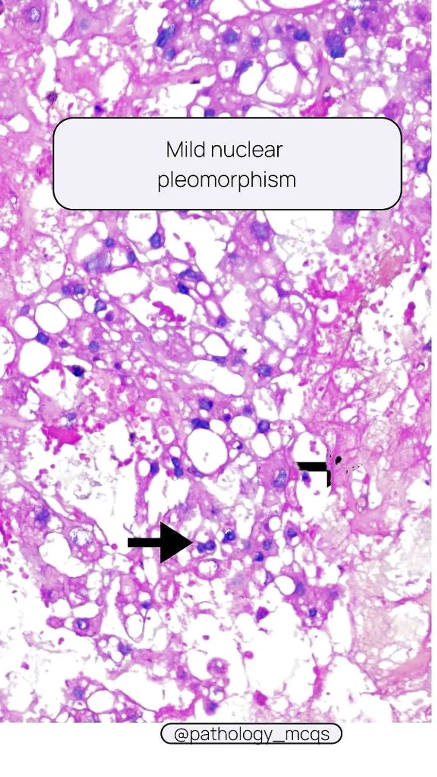 Microscopic view of tumor tissue showing myxoid stroma with mild nuclear pleomorphism and vacuolated cells.