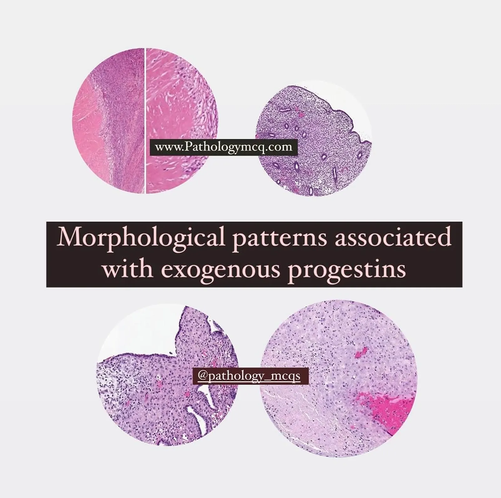 Morphological endometrial patterns associated with exogenous progestins