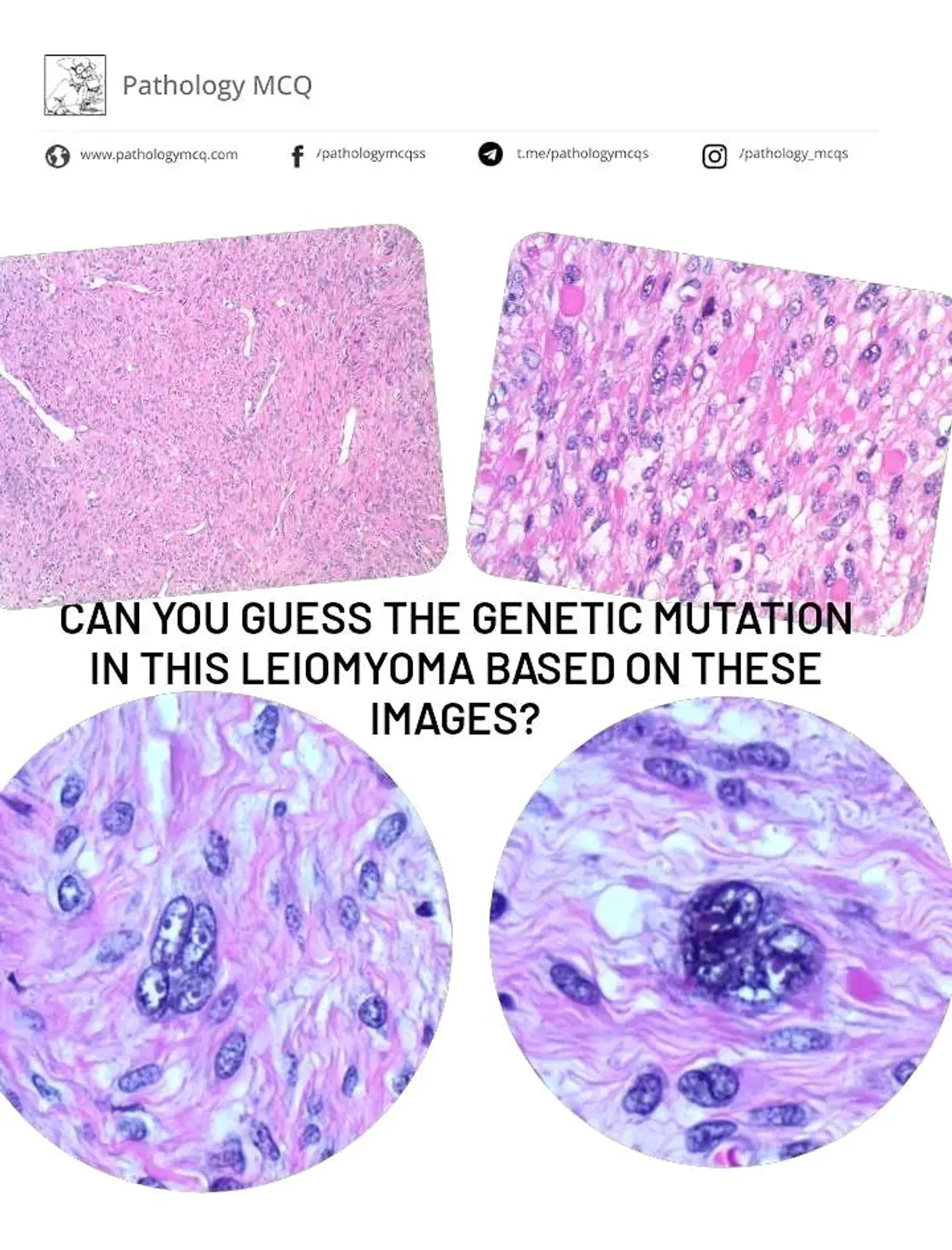 CAN YOU GUESS THE MUTATION IN THIS LEIOMYOMA BASED ON THESE IMAGES?