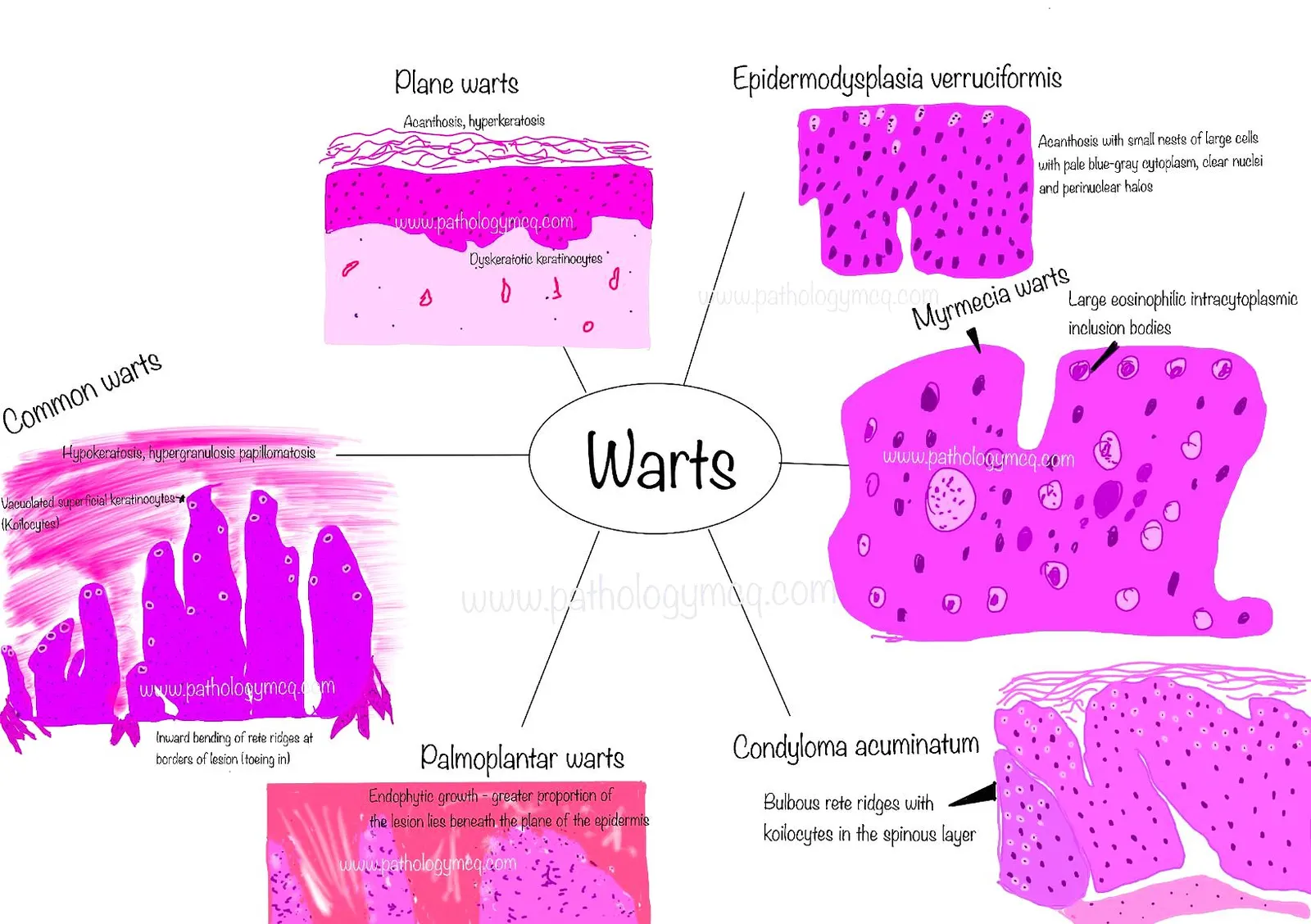 HISTOPATHOLOGIC FINDINGS OF WARTS - SUMMARY