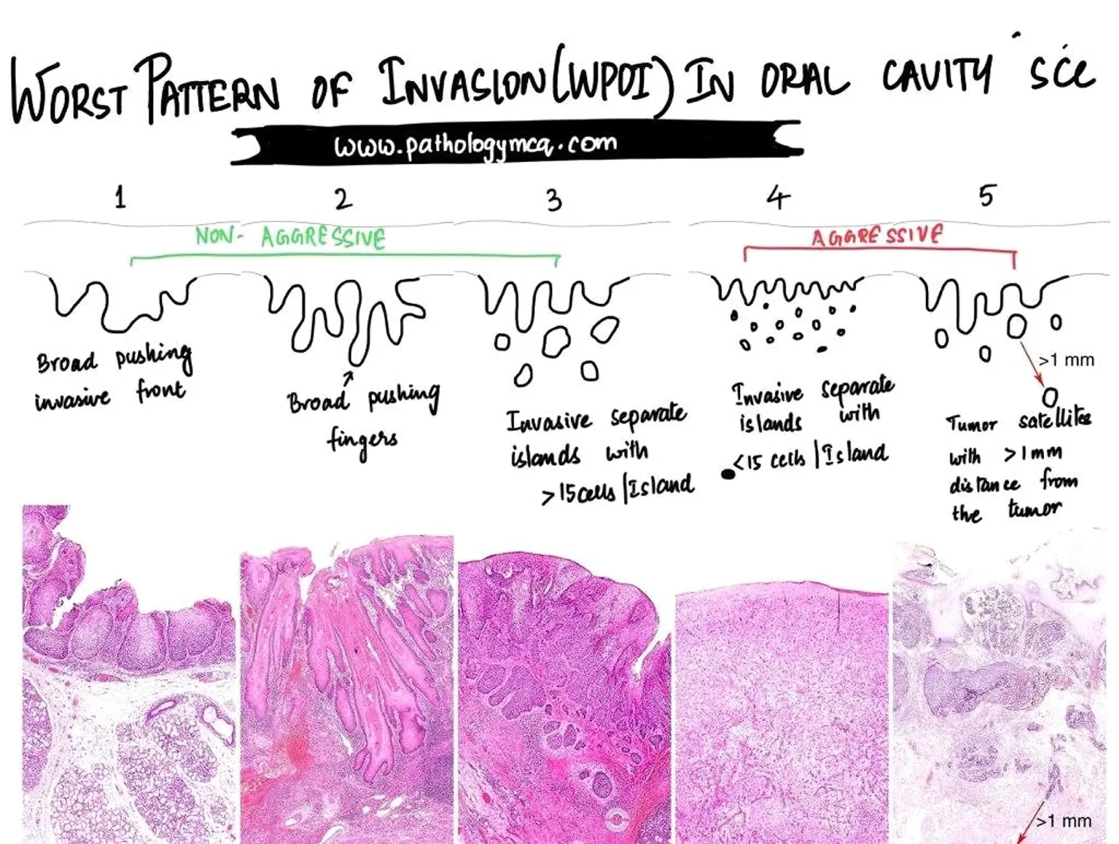 Diagram showing all five Worst Pattern of Invasion (WPOI) types in oral squamous cell carcinoma, from non-aggressive (Type 1–3) to aggressive (Type 4–5) patterns with corresponding histopathology slides.