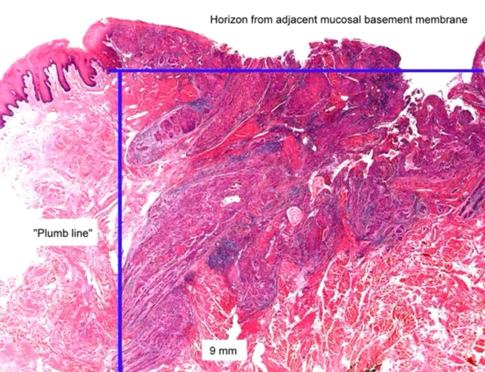 Histopathologic image of oral squamous cell carcinoma demonstrating how depth of invasion (DOI) is measured using a plumb line from the basement membrane of adjacent normal mucosa.
