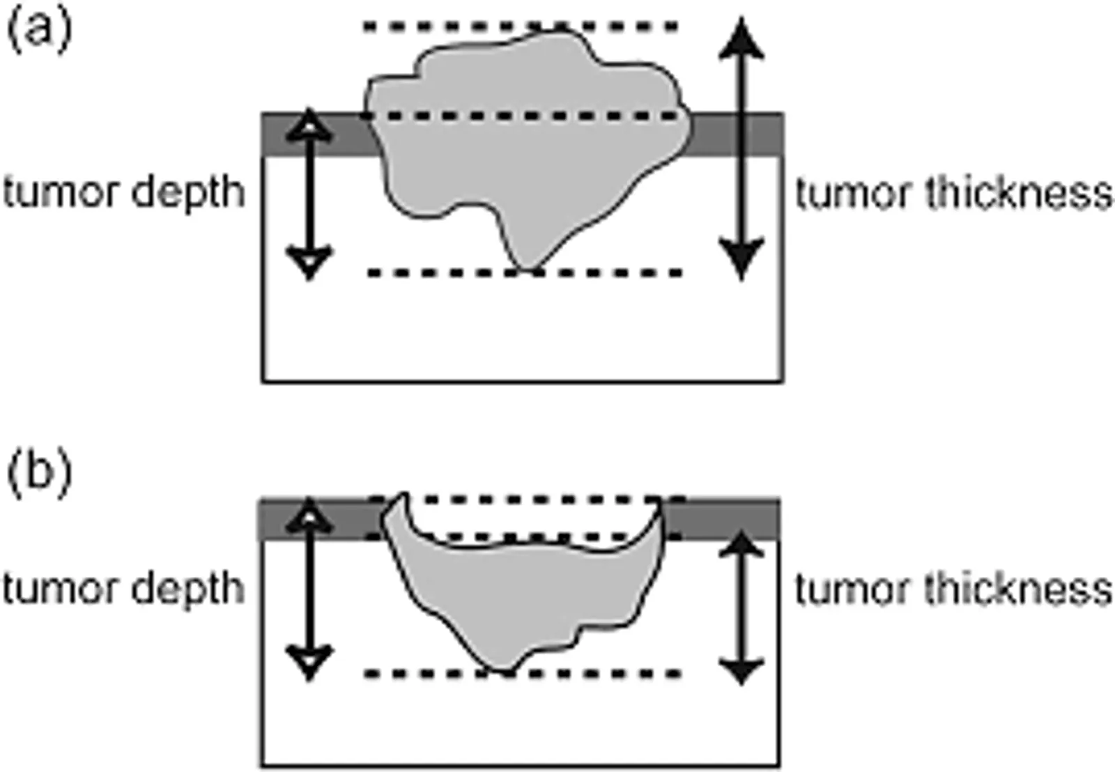 Diagram comparing tumor depth and tumor thickness measurements in oral squamous cell carcinoma, showing differences between surface-based and basement-membrane-based reference points.