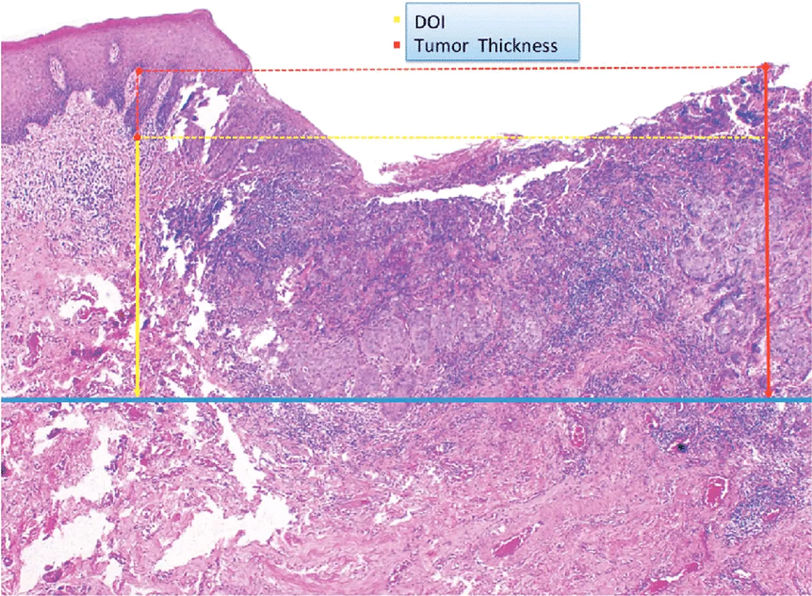 Histopathology image of oral squamous cell carcinoma showing measurement of tumor thickness and depth of invasion (DOI) using reference lines from the surface epithelium and basement membrane.