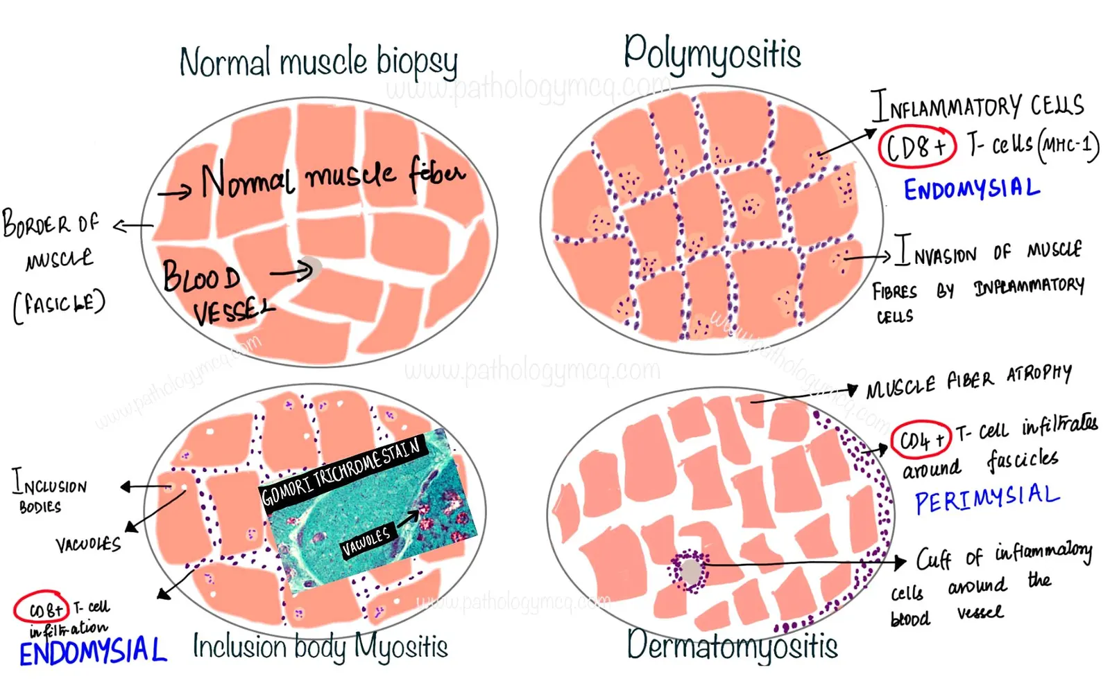 Histologic findings of inflammatory myopathies