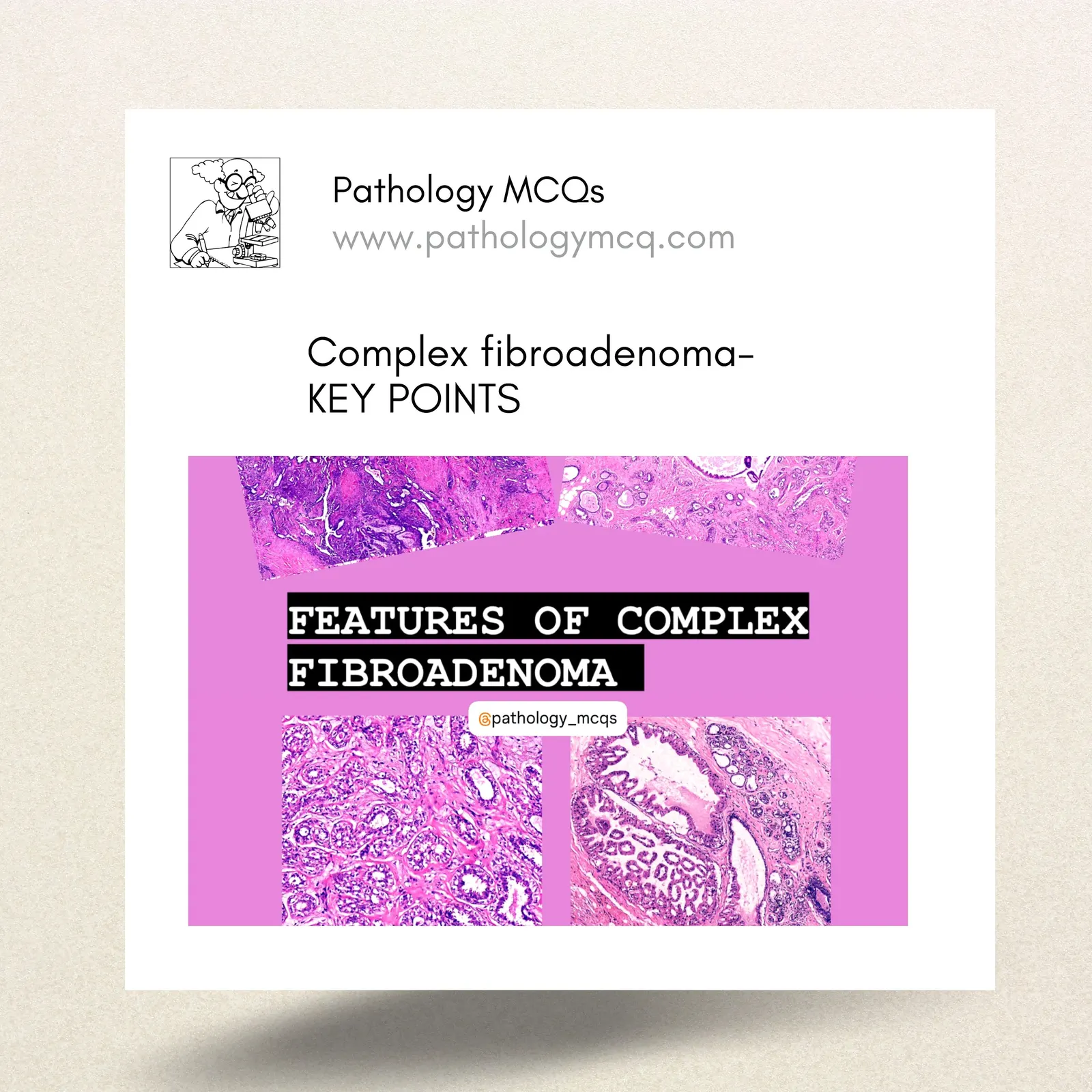 Complex fibroadenoma- Key Features