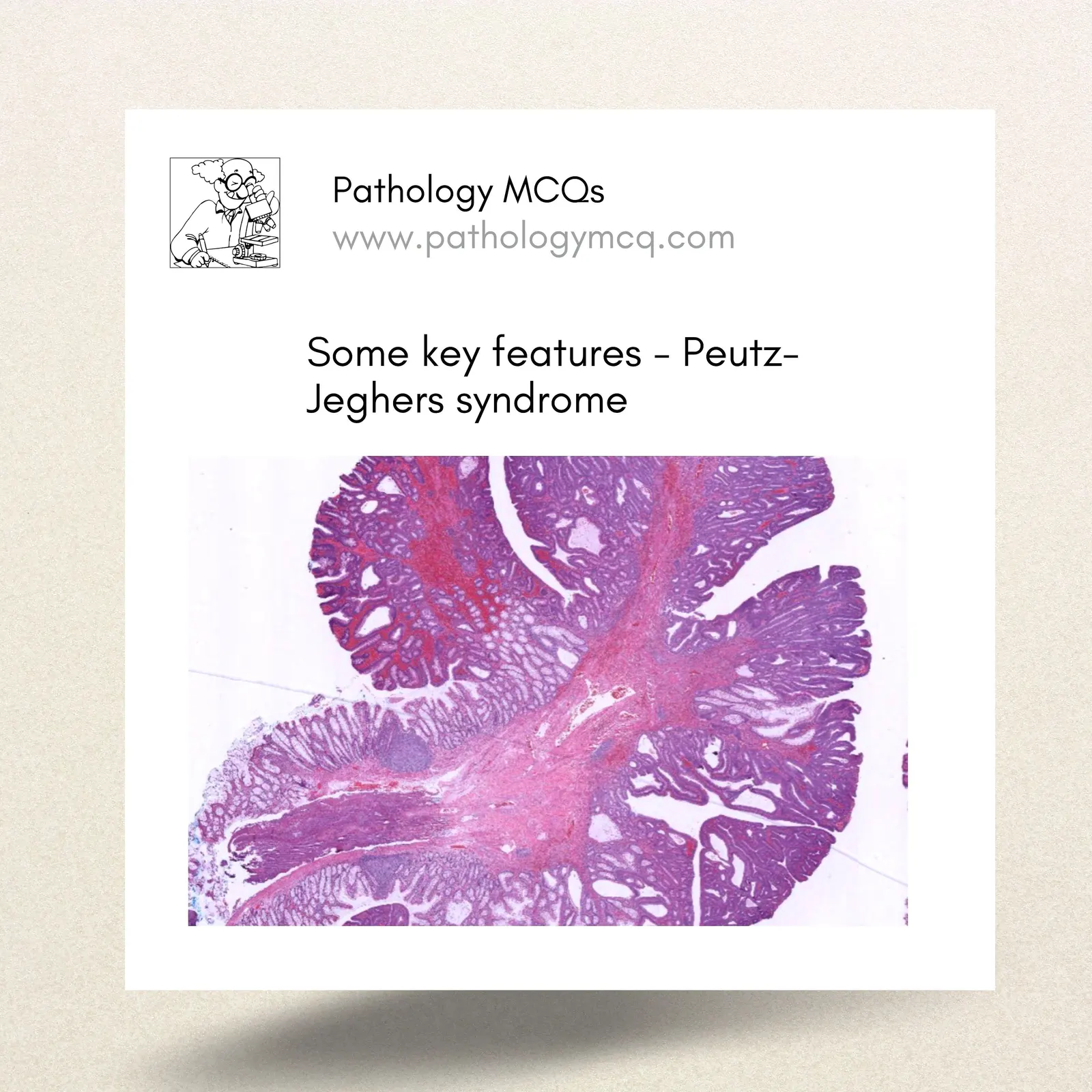 All about Peutz-Jeghers syndrome