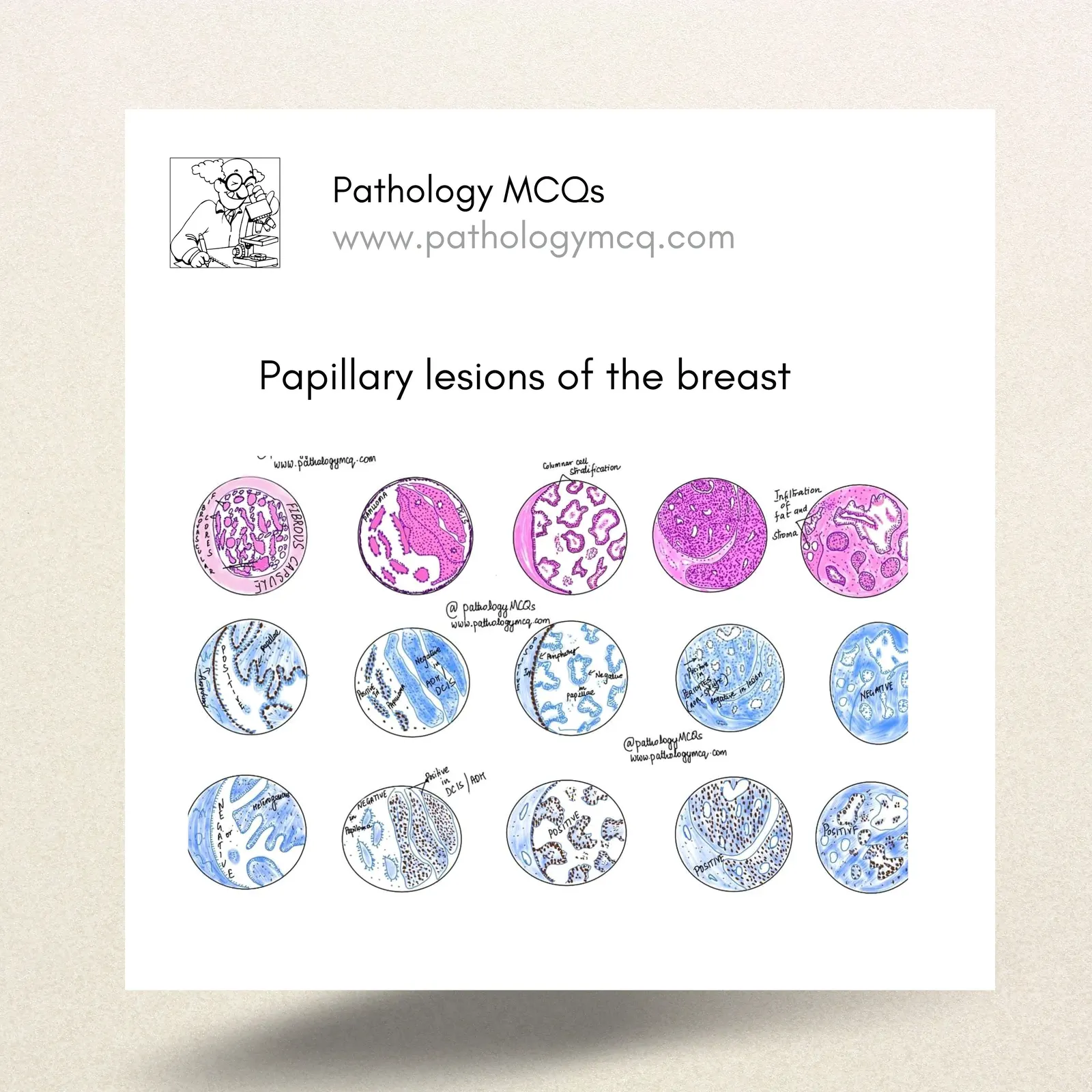 Understanding Papillary Breast Lesions: A Comprehensive Overview