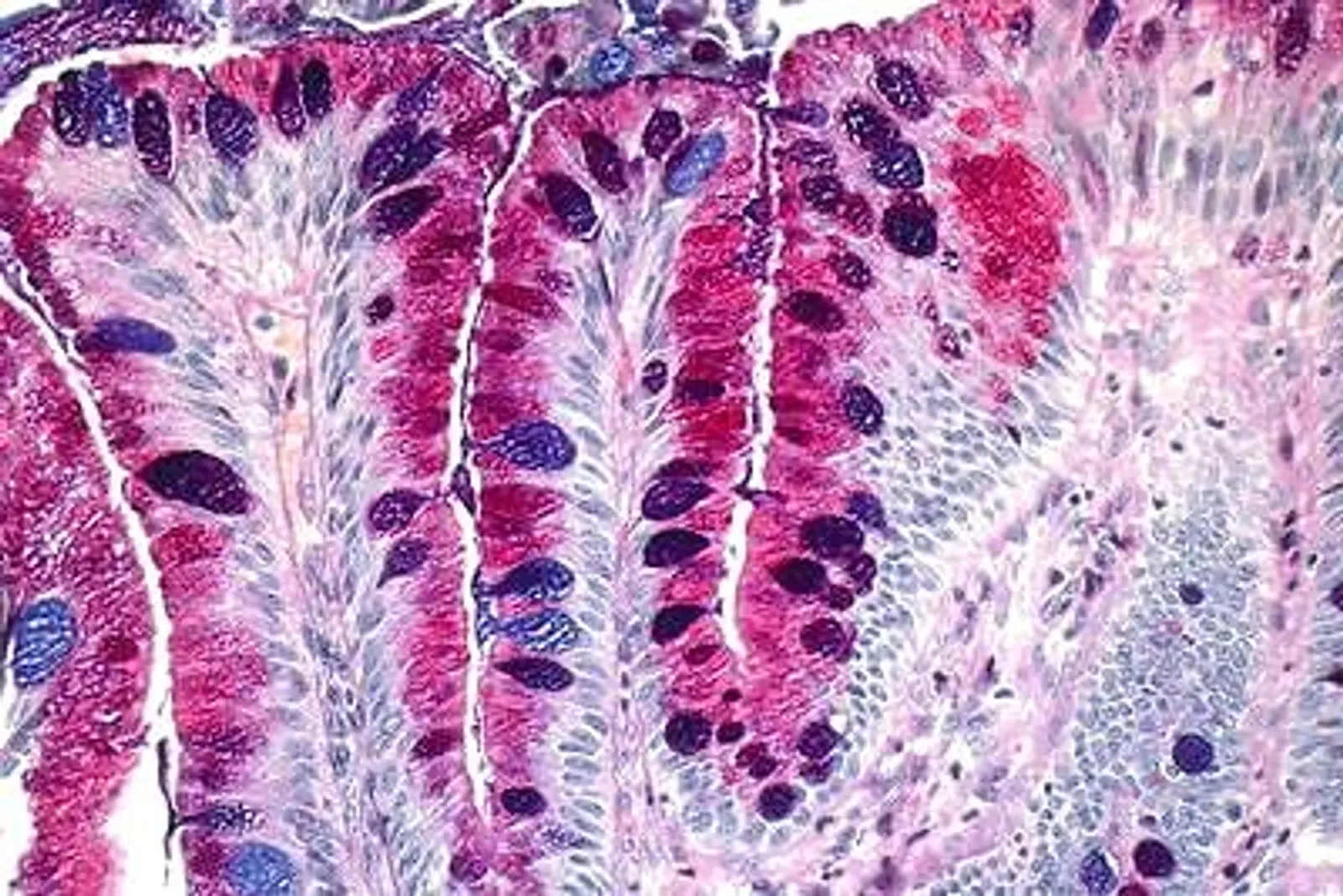PAS + Alcian blue stain showing purple colored goblet cells and magenta colored gastric foveolar cells