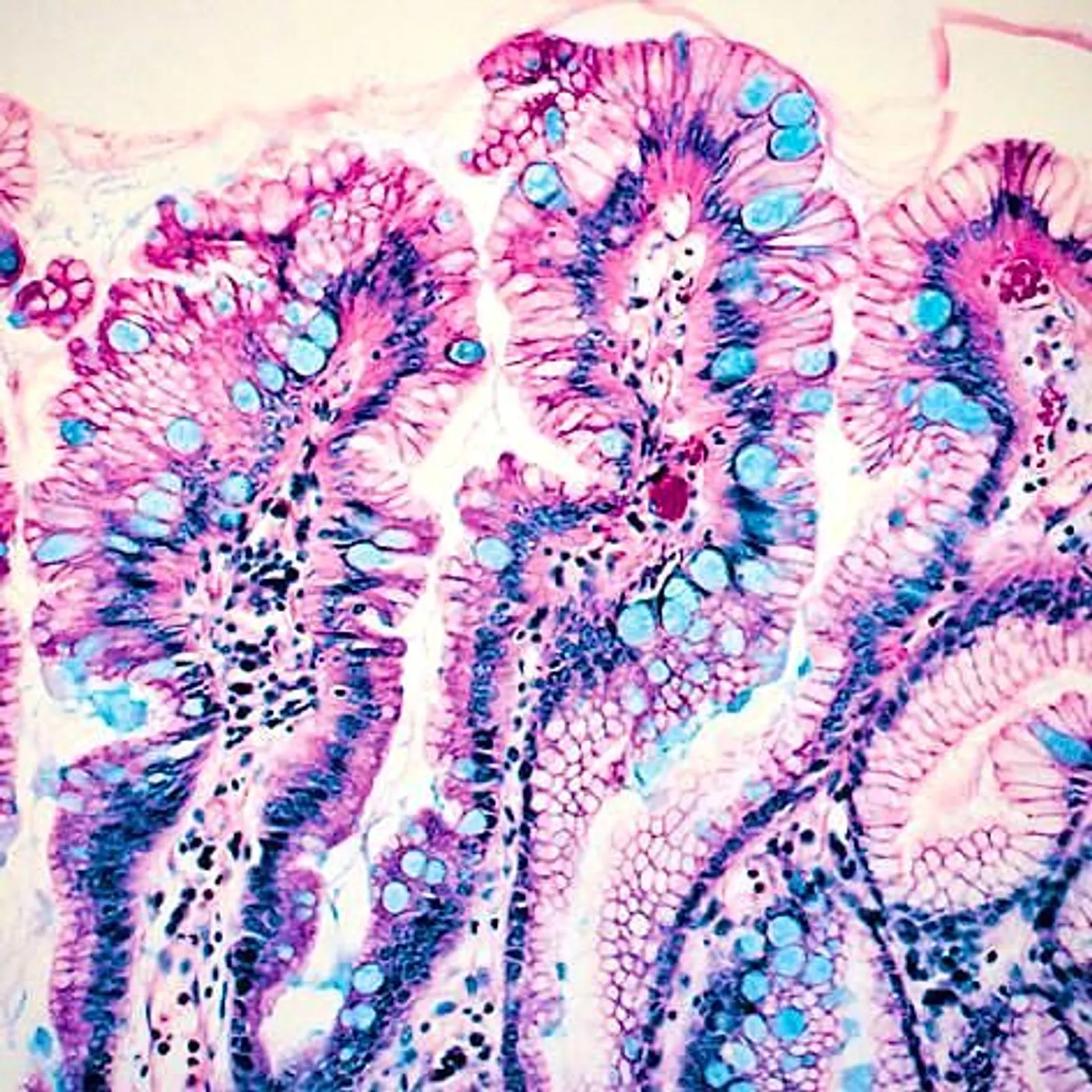 Alcian blue staining of barrett mucosa