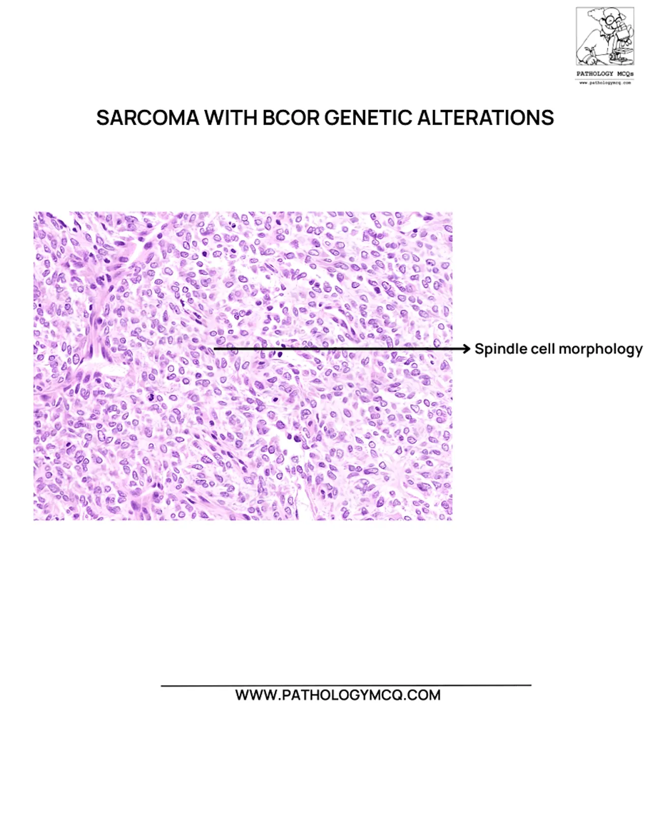 BCOR-Altered Undifferentiated Round Cell Sarcoma Histopathology Spindle cell morphology in BCOR-altered undifferentiated round cell sarcoma on H&E stain.