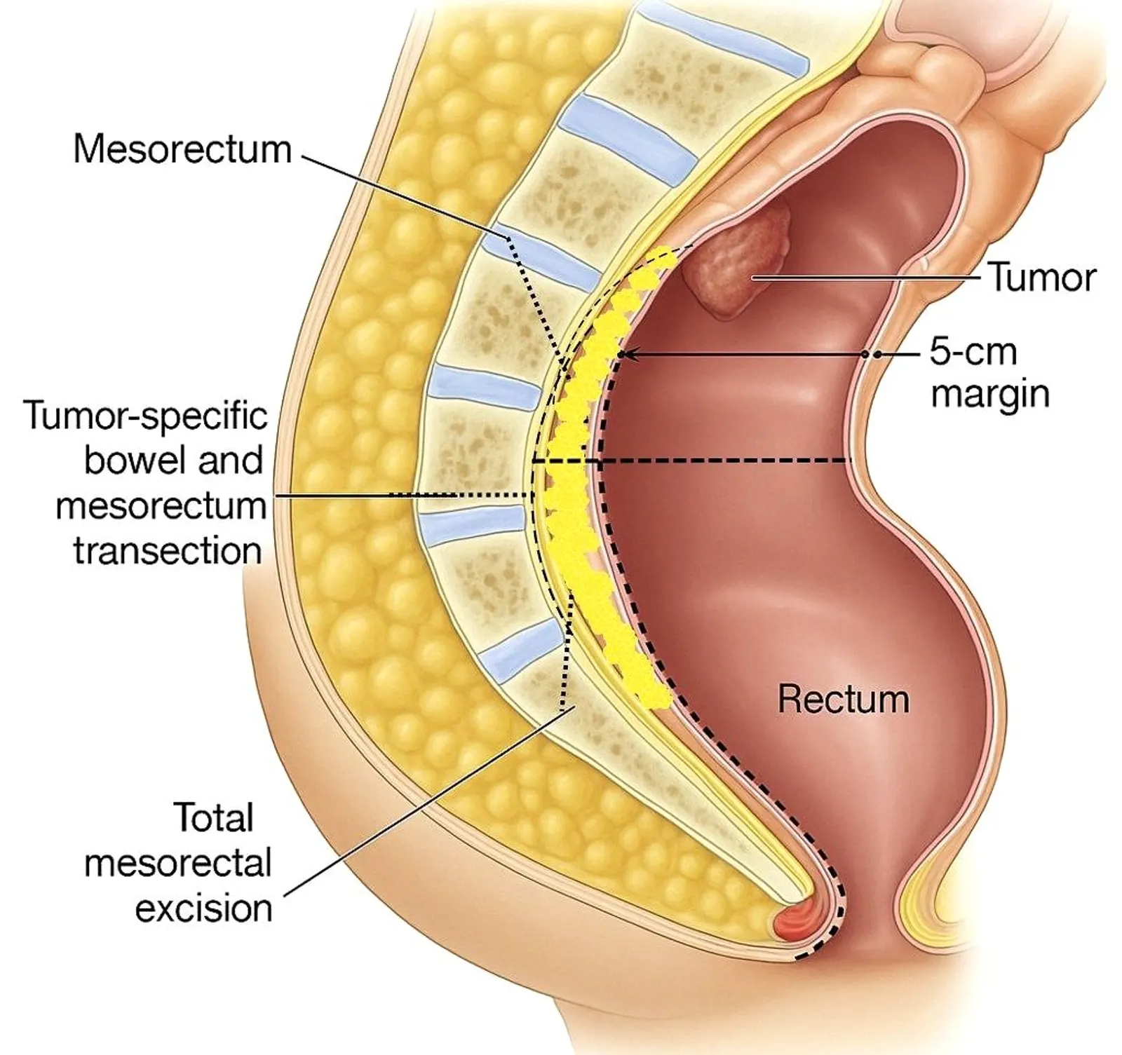 Diagram illustrating mesorectum anatomy, tumor location, 5-cm margin, and total mesorectal excision in relation to the rectum.