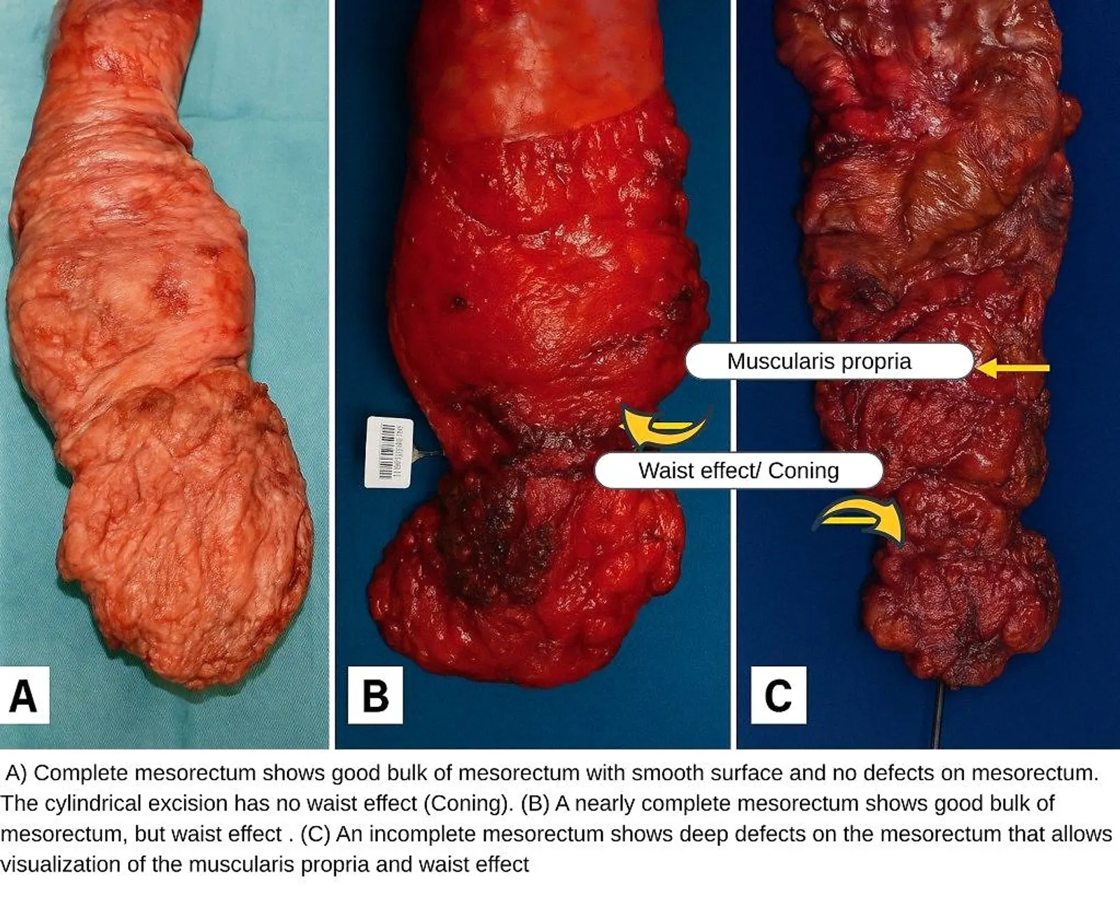 Anatomical comparison of complete, nearly complete, and incomplete mesorectum specimens, showing varying bulk and surface conditions.