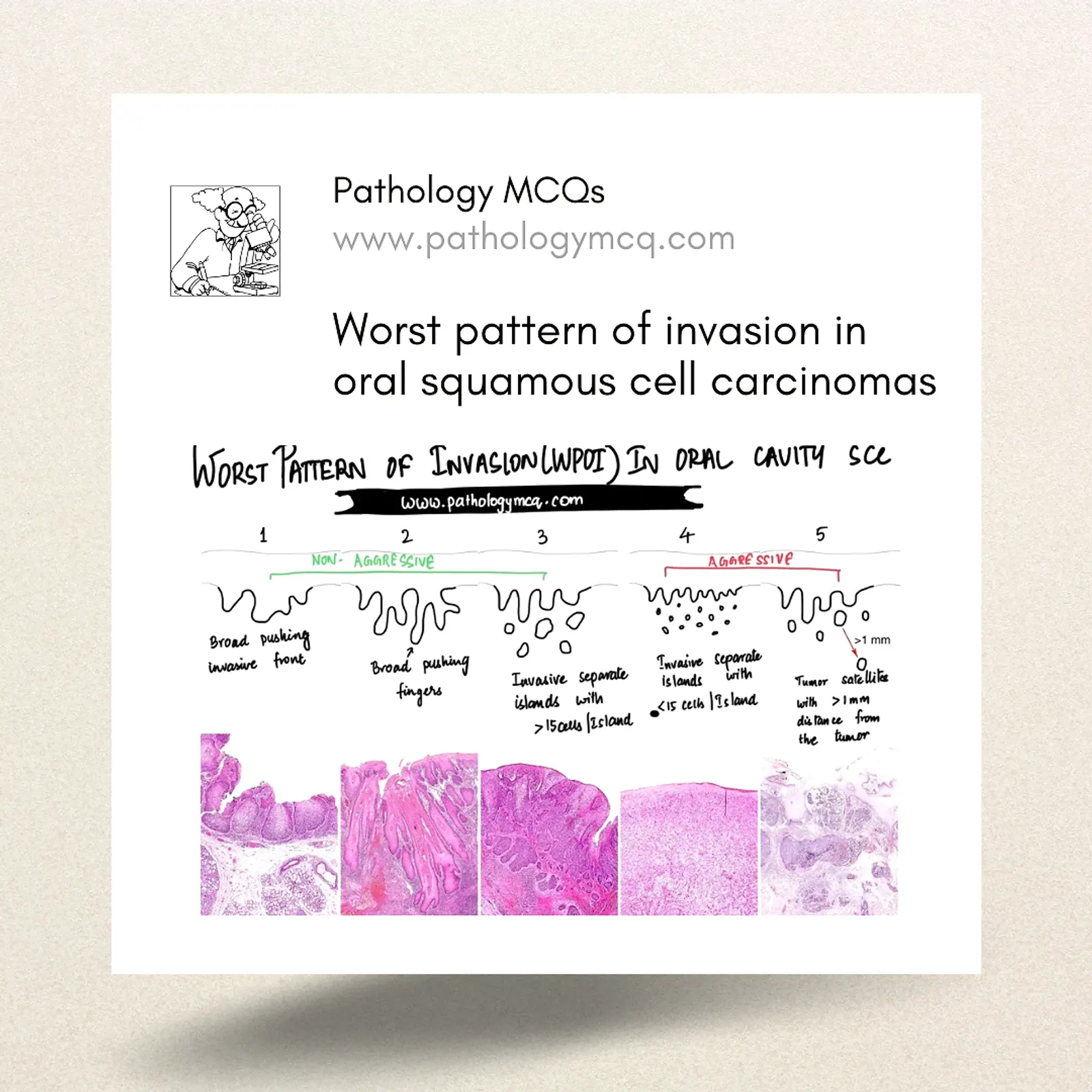 Understanding WPOI in Oral Squamous Cell Carcinoma