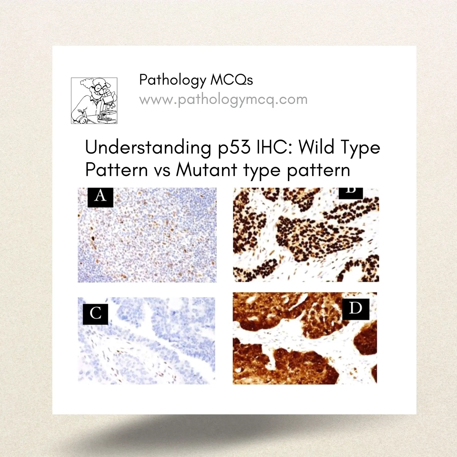 Understanding p53 IHC: Wild Type Pattern vs Mutant type pattern
