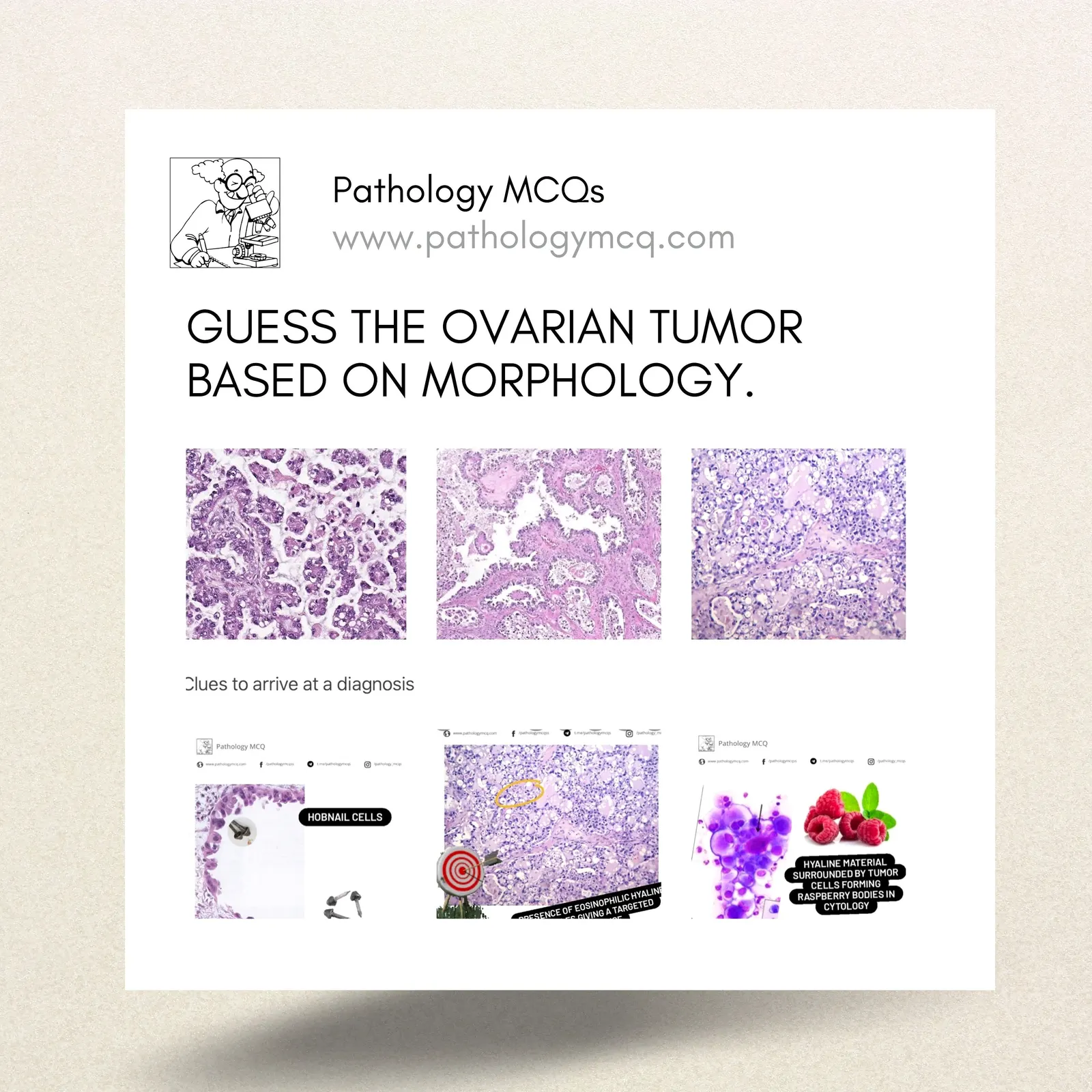 GUESS THE OVARIAN TUMOR BASED ON MORPHOLOGY.