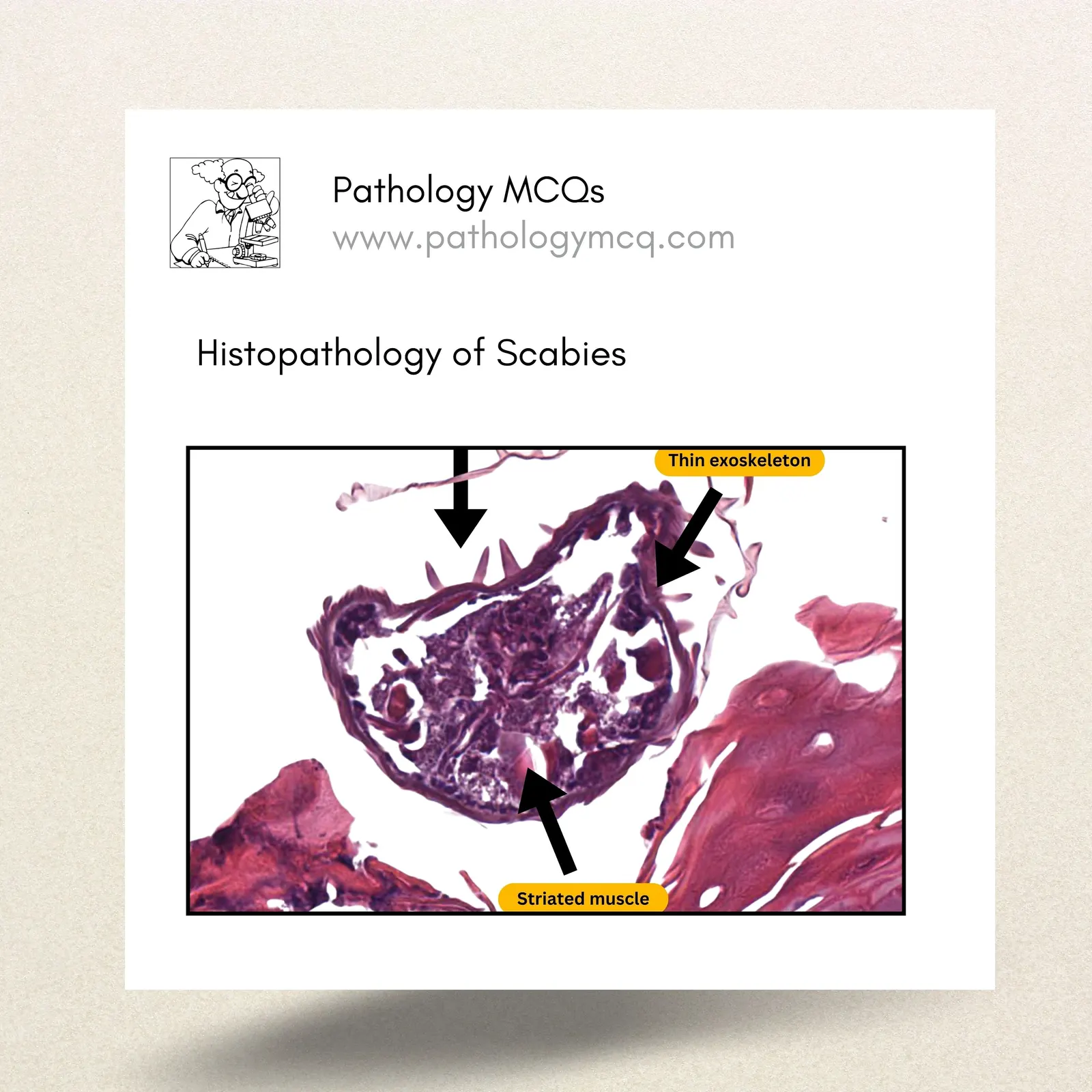 Histopathology of Scabies