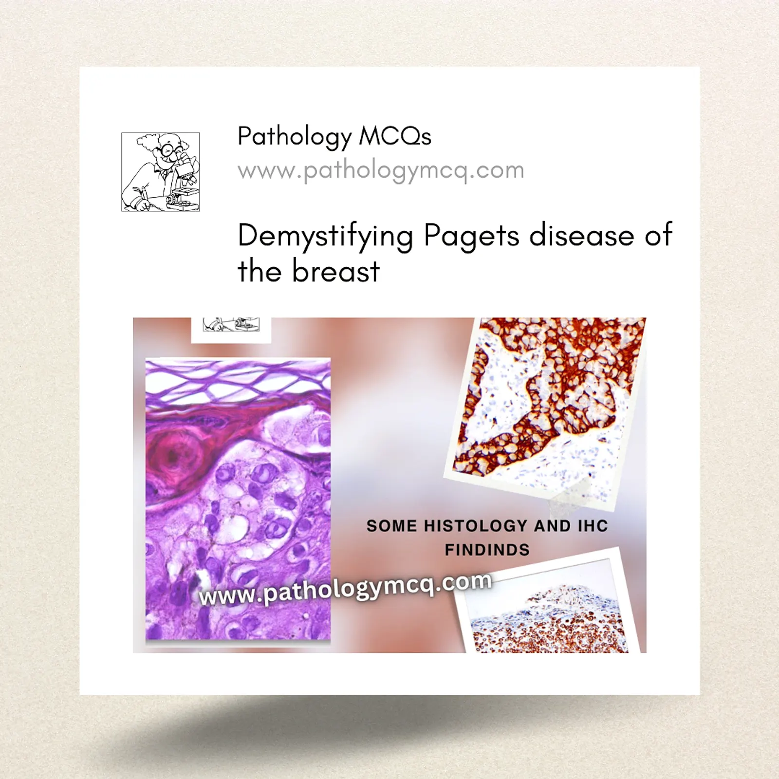 Paget's Disease of Breast: Histology and Immuno- histochemistry