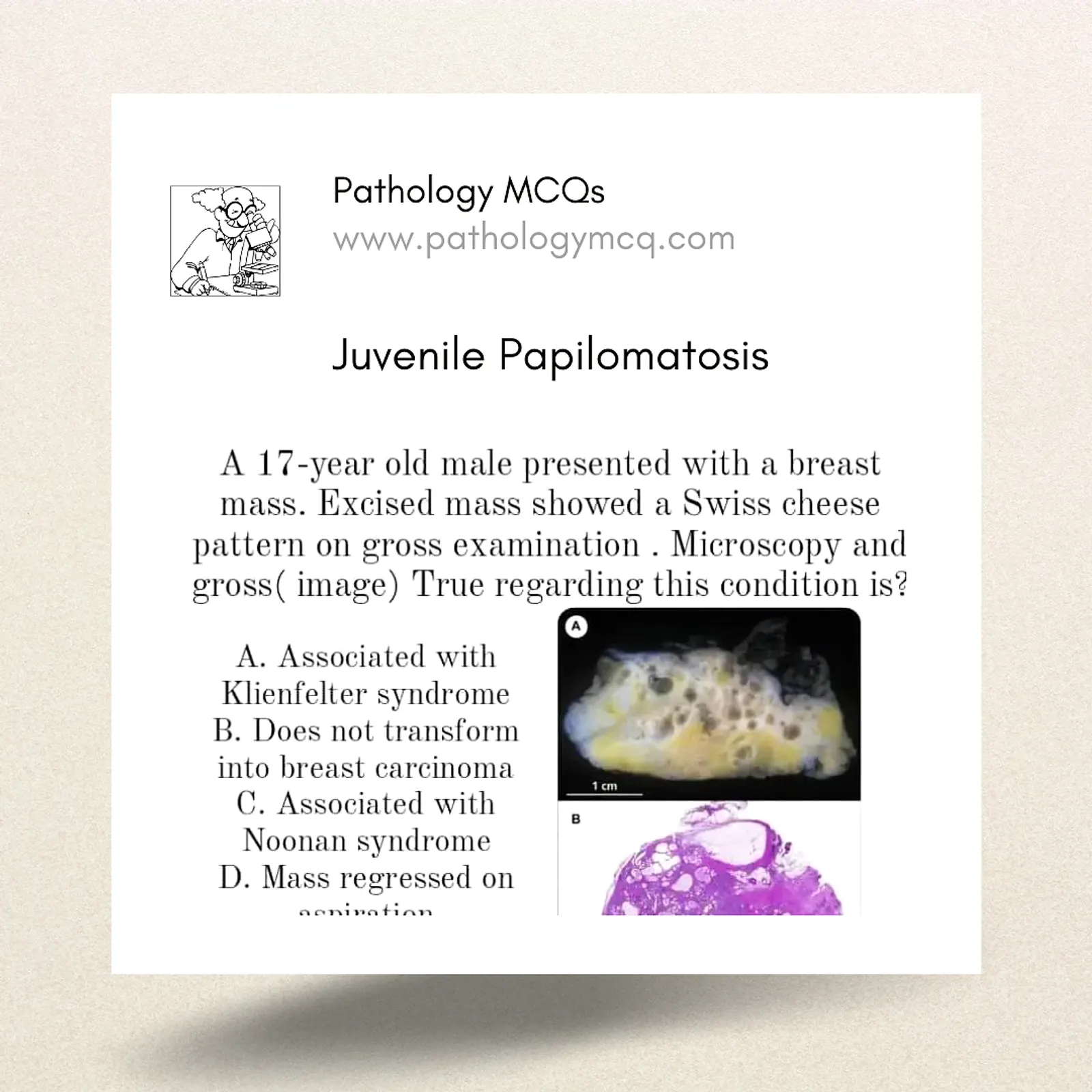 Juvenile Papillomatosis: A Comprehensive Overview from Gross to Microscopic Examination