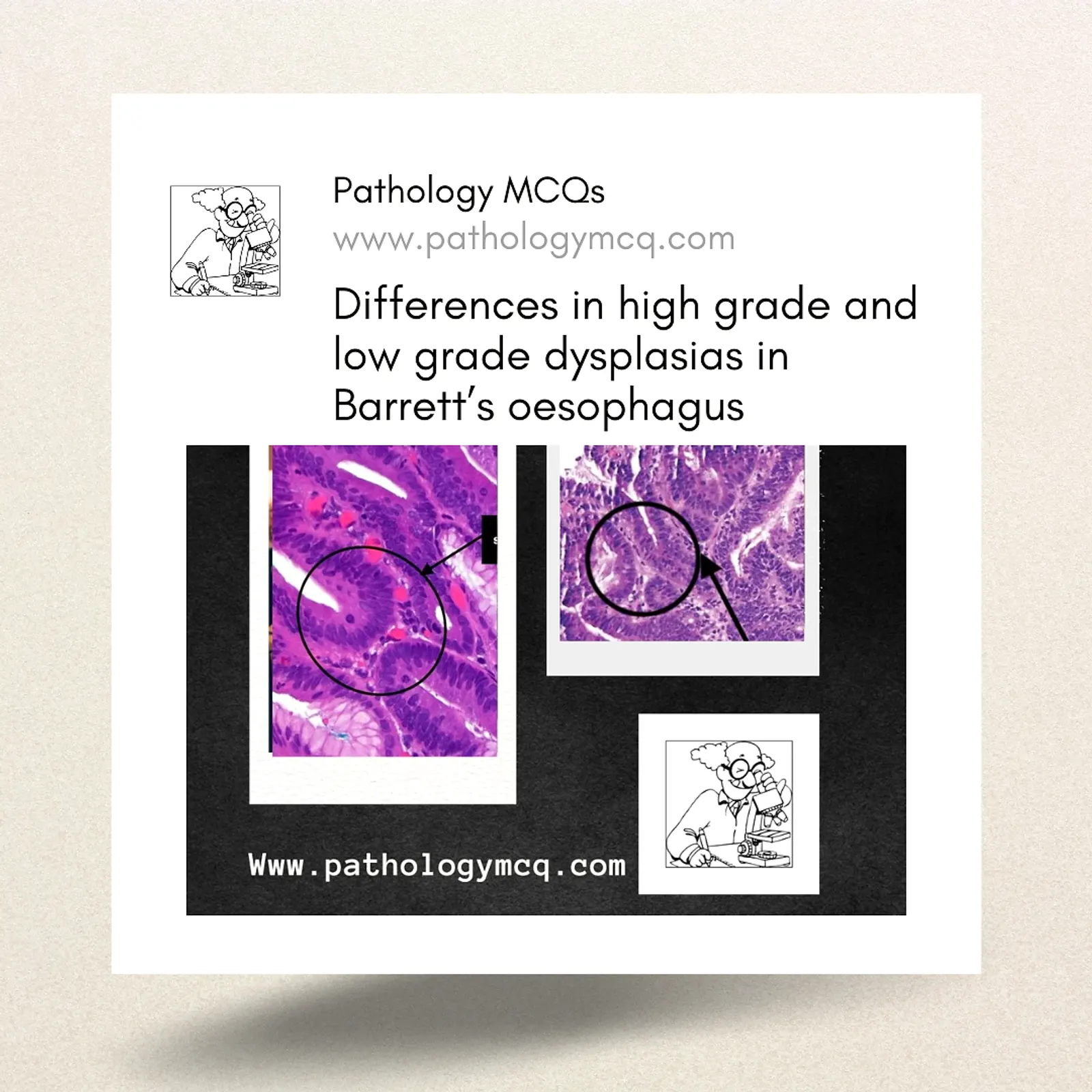 Understanding the Differences: Low-Grade and High-Grade Dysplasia in Barrett's Esophagus
