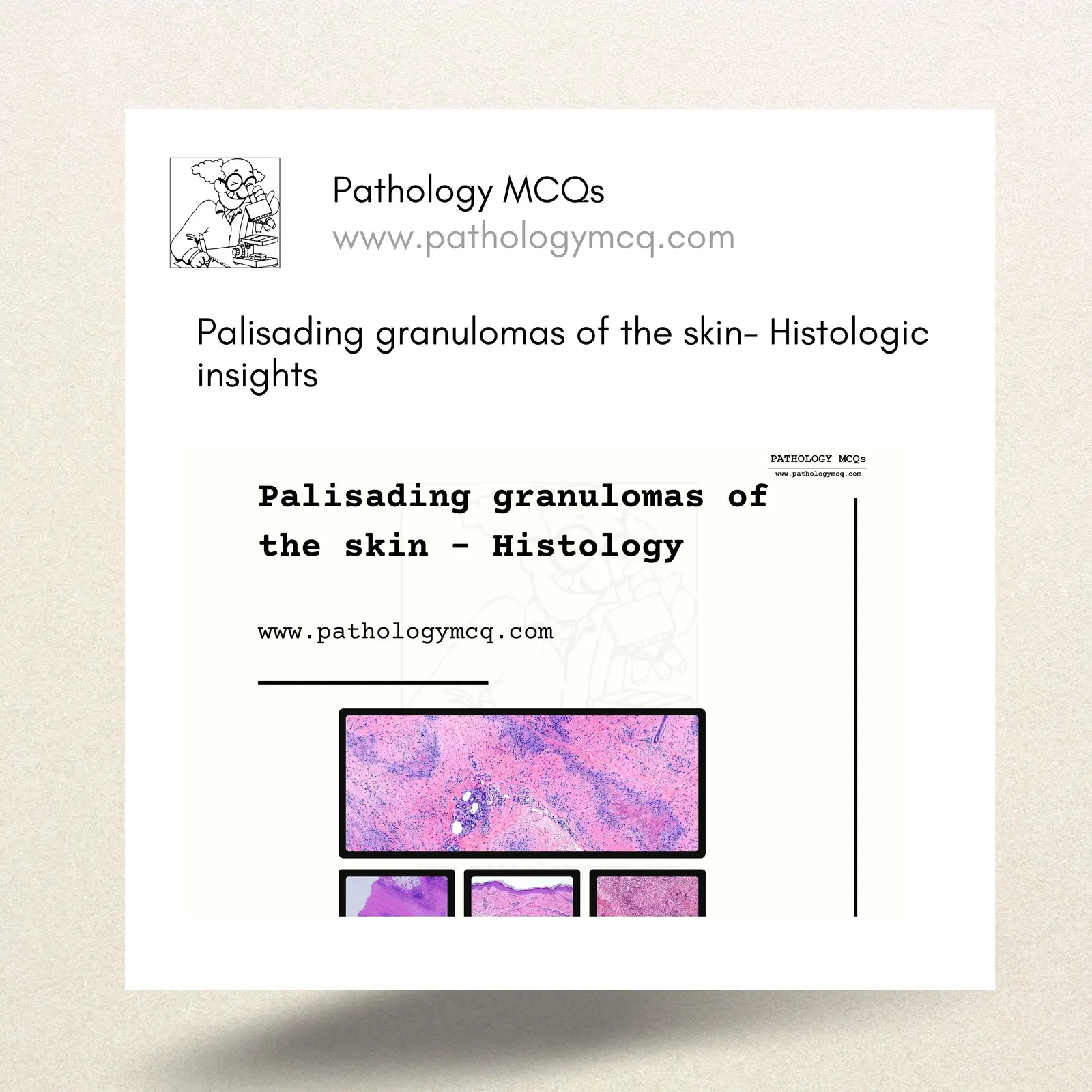 Palisading Granulomas of the Skin: Histological Insights