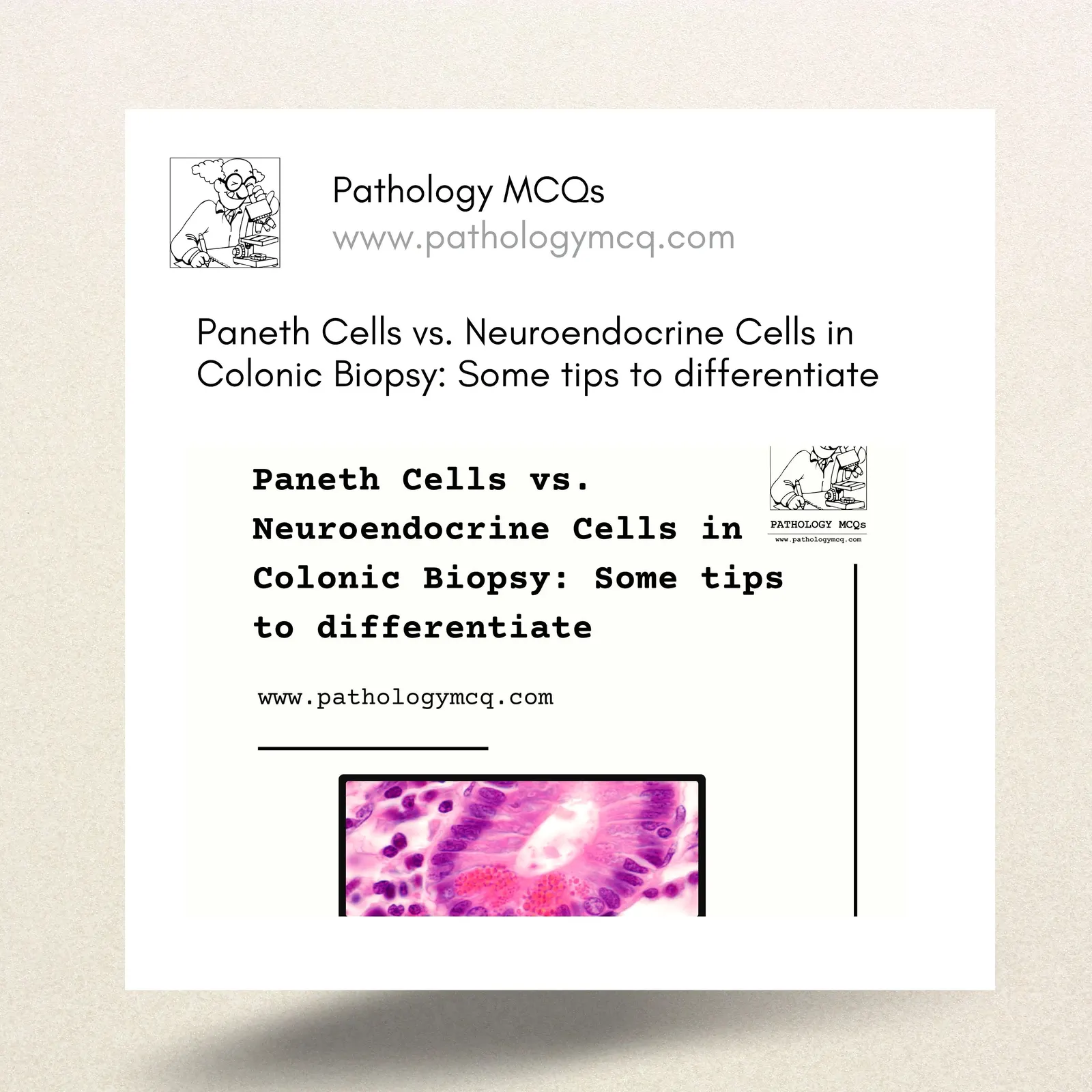 Paneth Cells vs. Neuroendocrine Cells in Colonic Biopsy: Some tips to differentiate