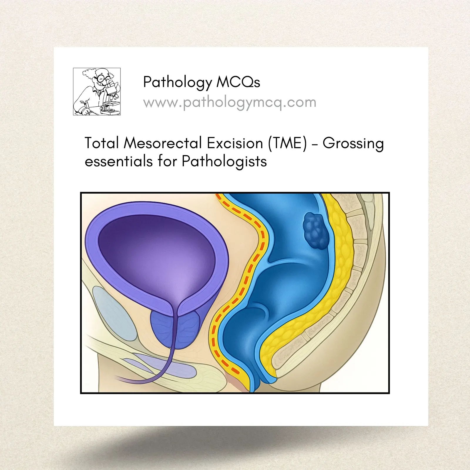 Total Mesorectal Excision (TME) – Grossing essentials for Pathologists