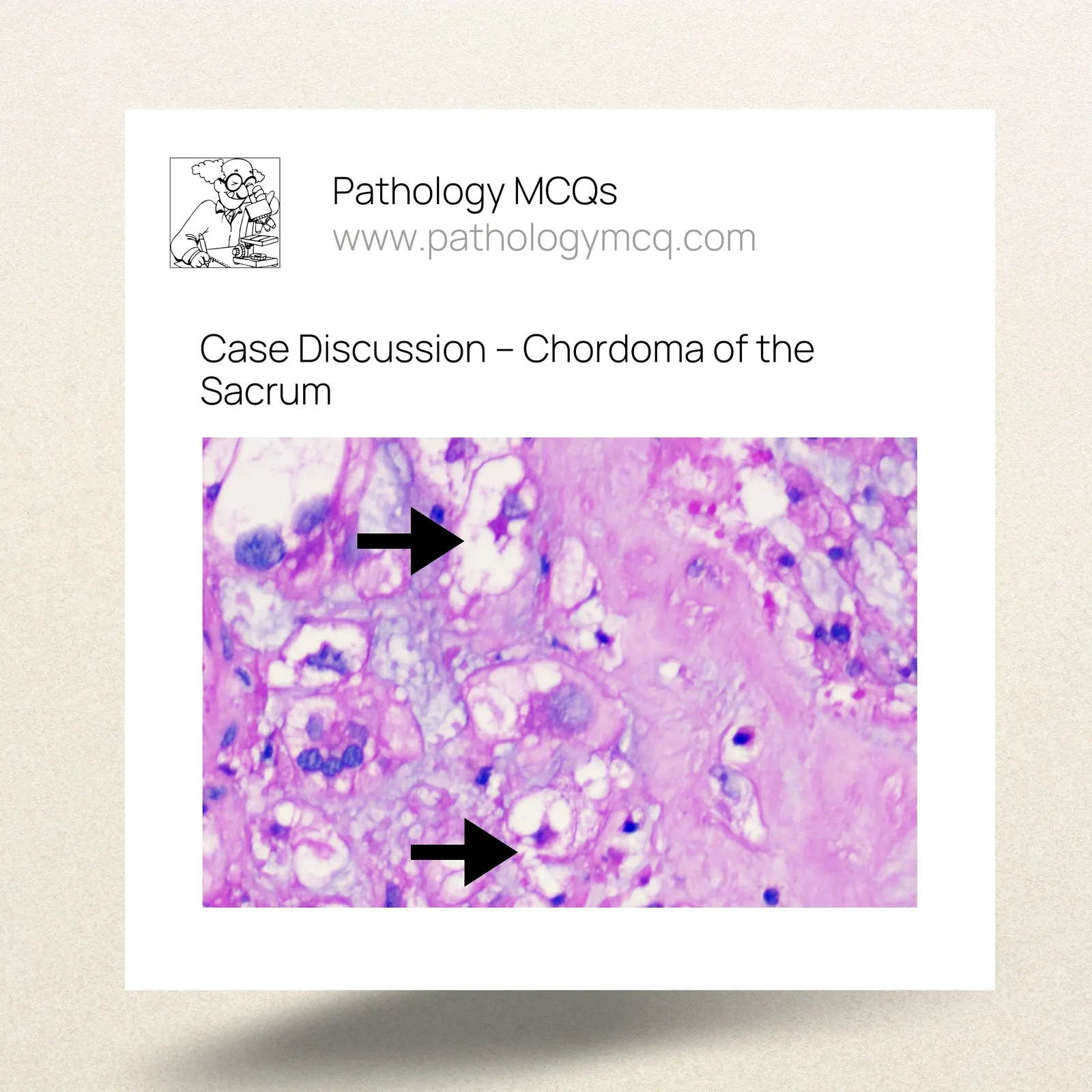 Understanding Chordoma: Diagnosis and Pathology