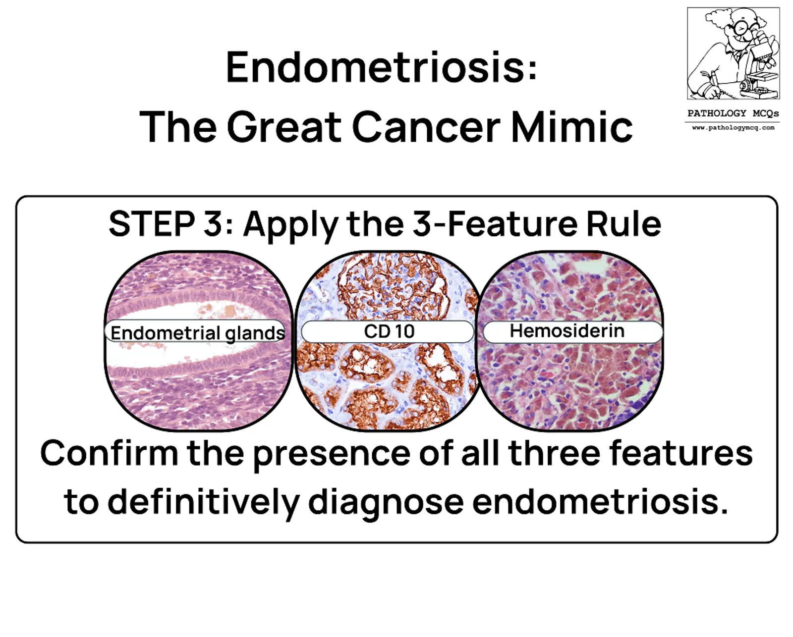 Illustration describing Endometriosis with the title 'Endometriosis: The Great Cancer Mimic'. It features three labeled images: 'Endometrial glands', 'CD 10', and 'Hemosiderin', along with instructions to apply the 3-Feature Rule for diagnosing endometriosis.