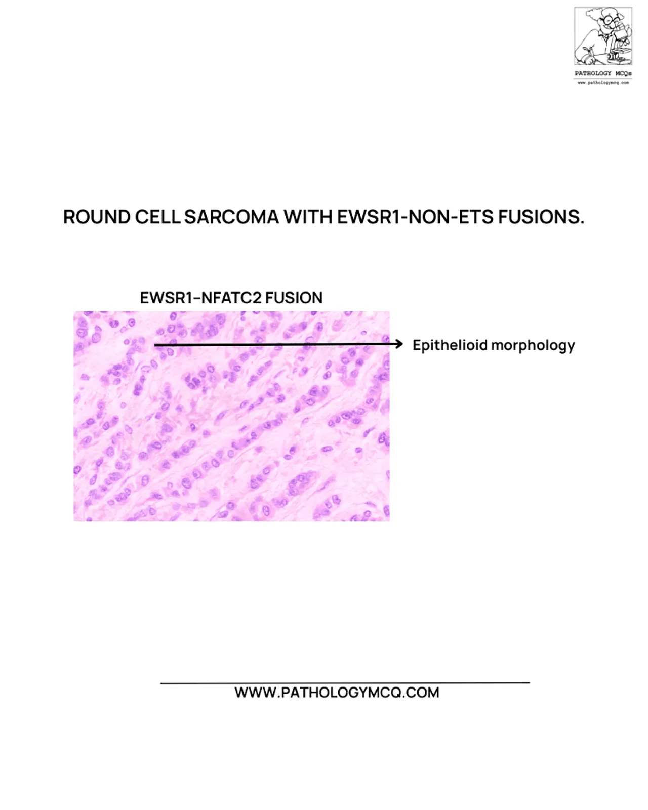 EWSR1-NFATC2 Fusion Undifferentiated Round Cell Sarcoma Histology Epithelioid tumor cells arranged in cords and sheets in EWSR1-NFATC2 fusion undifferentiated round cell sarcoma.