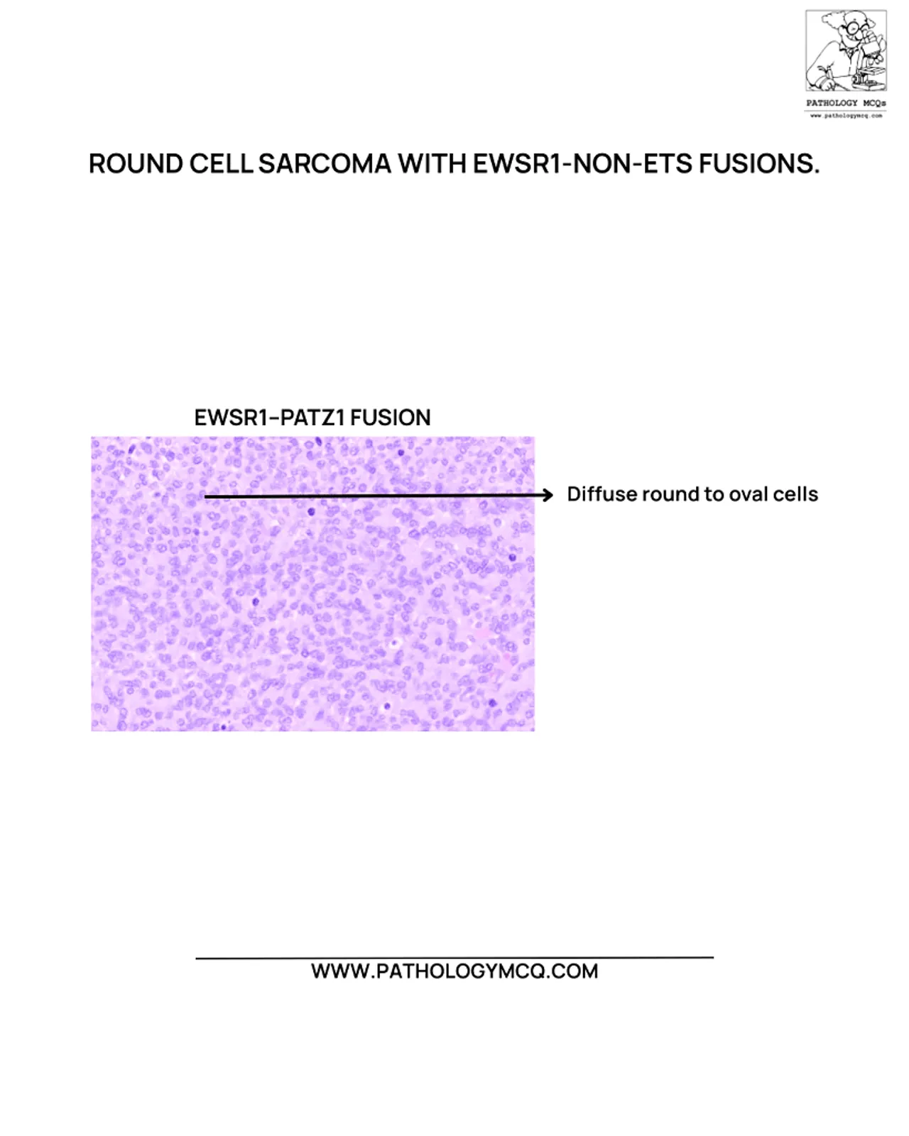 EWSR1-PATZ1 Fusion Sarcoma Histopathology Diffuse sheets of round to oval tumor cells in EWSR1-PATZ1 fusion undifferentiated round cell sarcoma.
