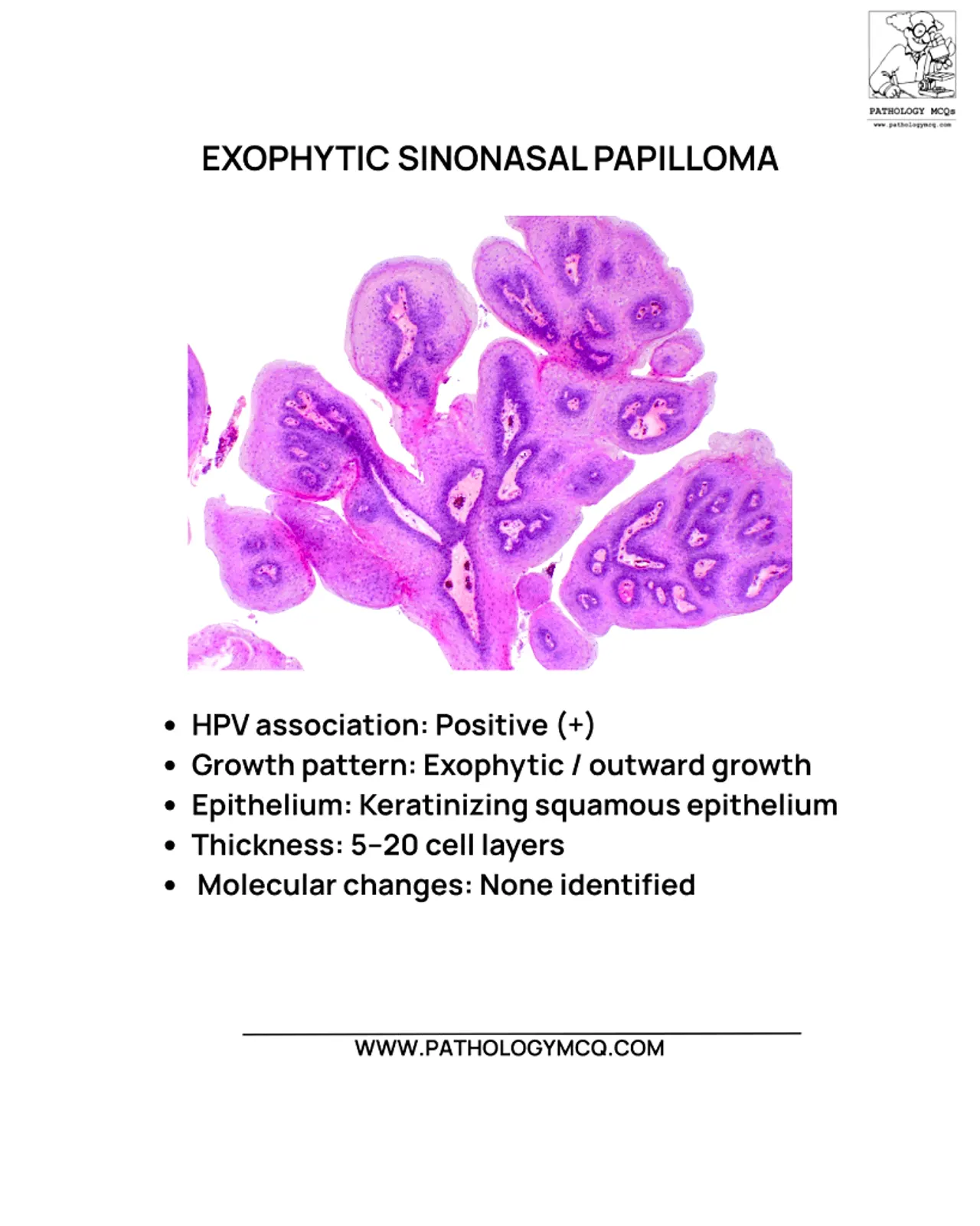 Exophytic sinonasal papilloma histology showing outward papillary squamous growth