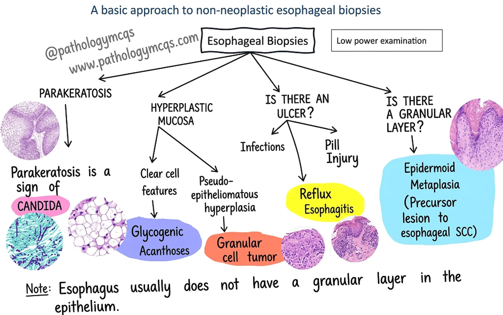 Flowchart explaining non-neoplastic esophageal biopsies, detailing conditions such as parakeratosis, hyperplastic mucosa, and various related lesions, including an illustration of microscopic features.