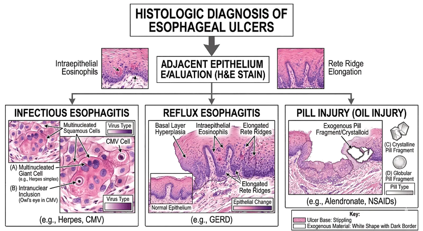 Diagram illustrating histologic diagnosis of esophageal ulcers, featuring sections for infectious esophagitis, reflux esophagitis, and pill injury. Each section includes detailed histological features with corresponding images and labels.