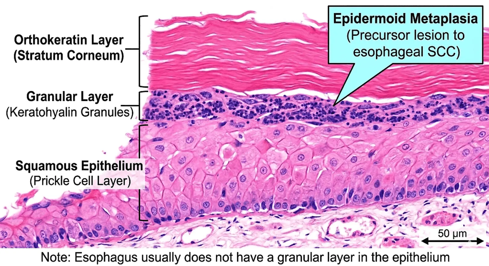 Microscopic view of esophageal tissue layers with labels for Orthokeratin Layer, Granular Layer, and Squamous Epithelium, highlighting Epidermoid Metaplasia as a precursor lesion to esophageal SCC.