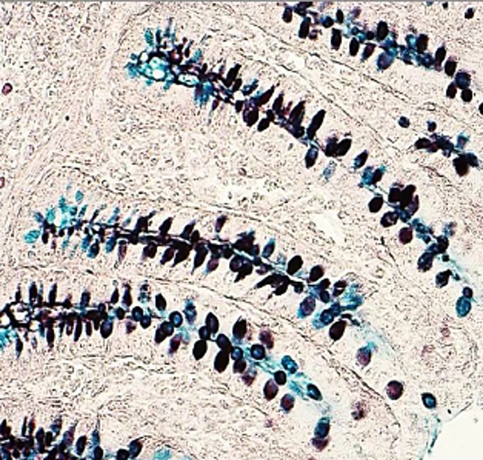 Carbohydrate staining- Sulfomucins stained brown with High iron diamine and few sialomucins stained blue.
