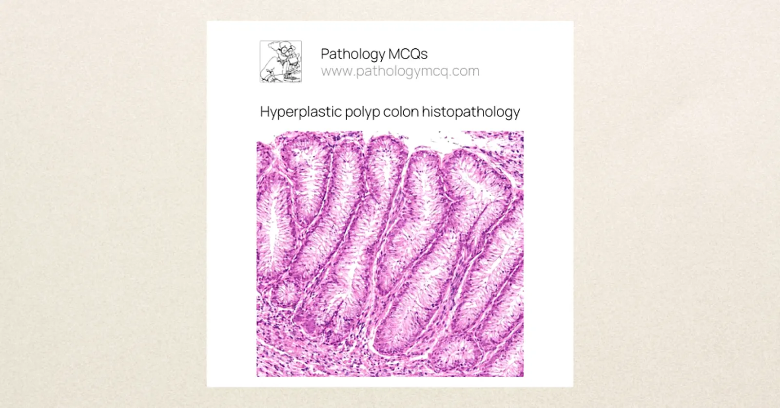 Hyperplastic polyp colon histopathology – serrated crypts on H&E Low power H&E microscopic image of hyperplastic polyp showing superficial serrated crypt architecture