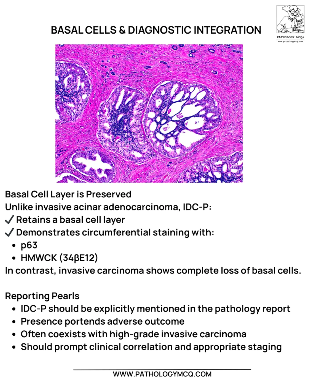 High‑power histology showing intraductal carcinoma of the prostate with preserved basal cell layer at the periphery of expanded ducts.