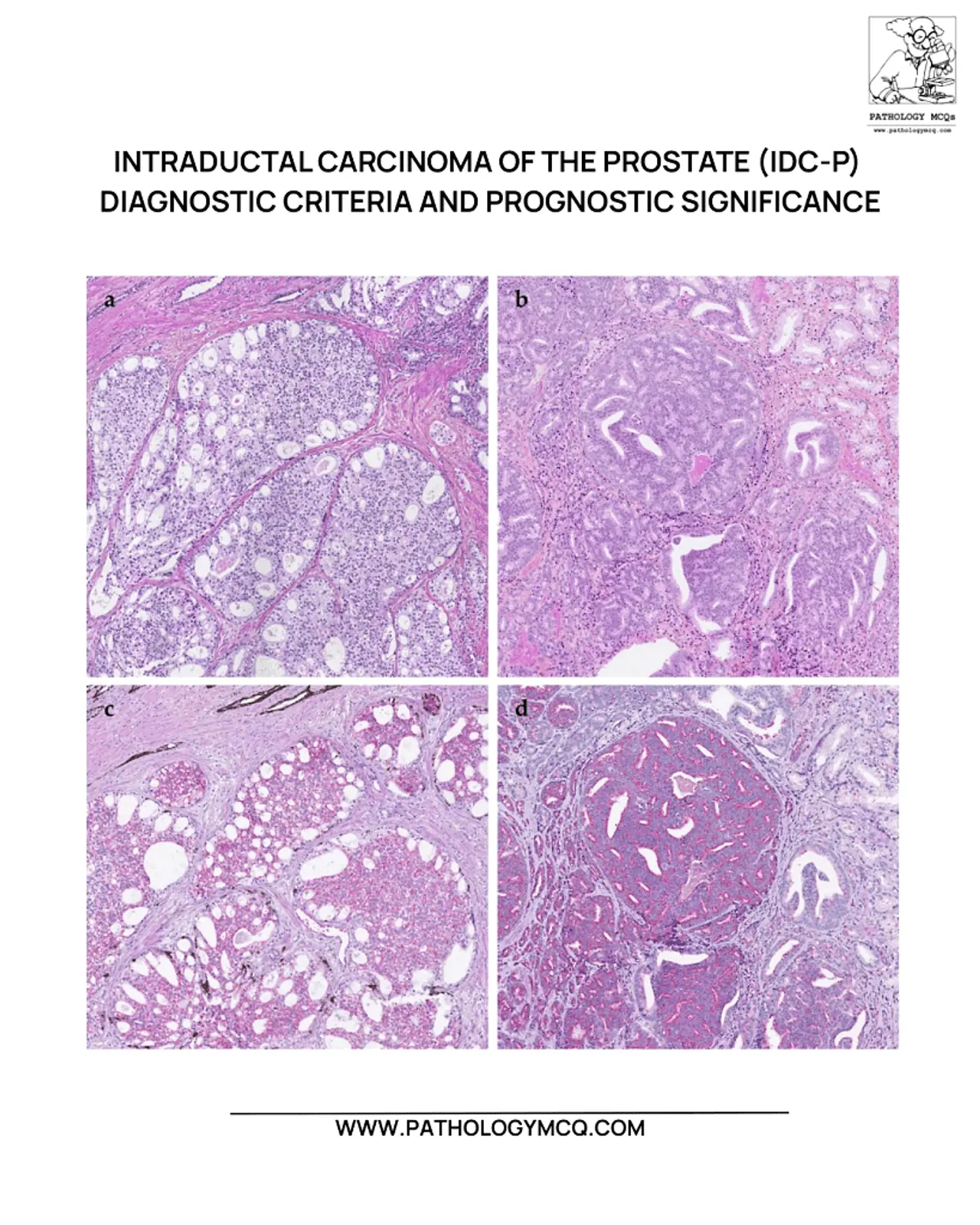 Histologic section showing solid and cribriform intraductal carcinoma of the prostate with markedly distended ducts and malignant epithelial cells.